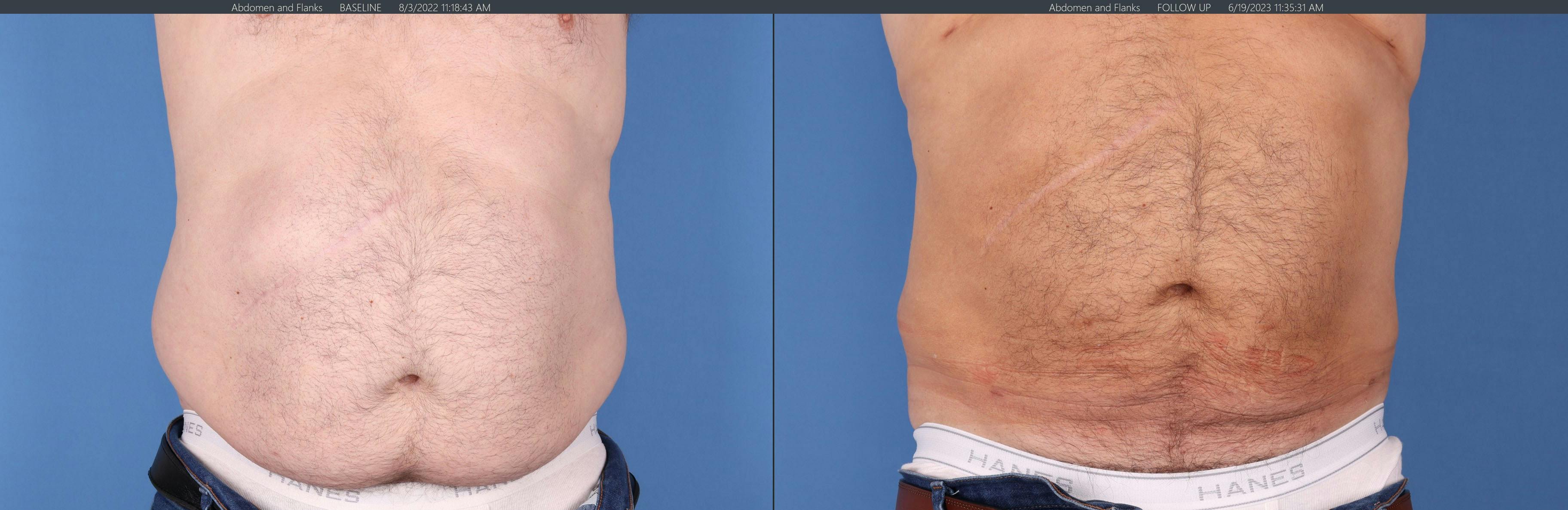 Abdomen Before & After Gallery - Patient 149385202 - Image 1