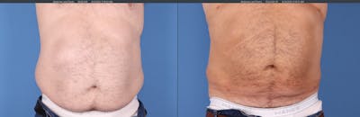 Tummy Tuck Before & After Gallery - Patient 149236567 - Image 1