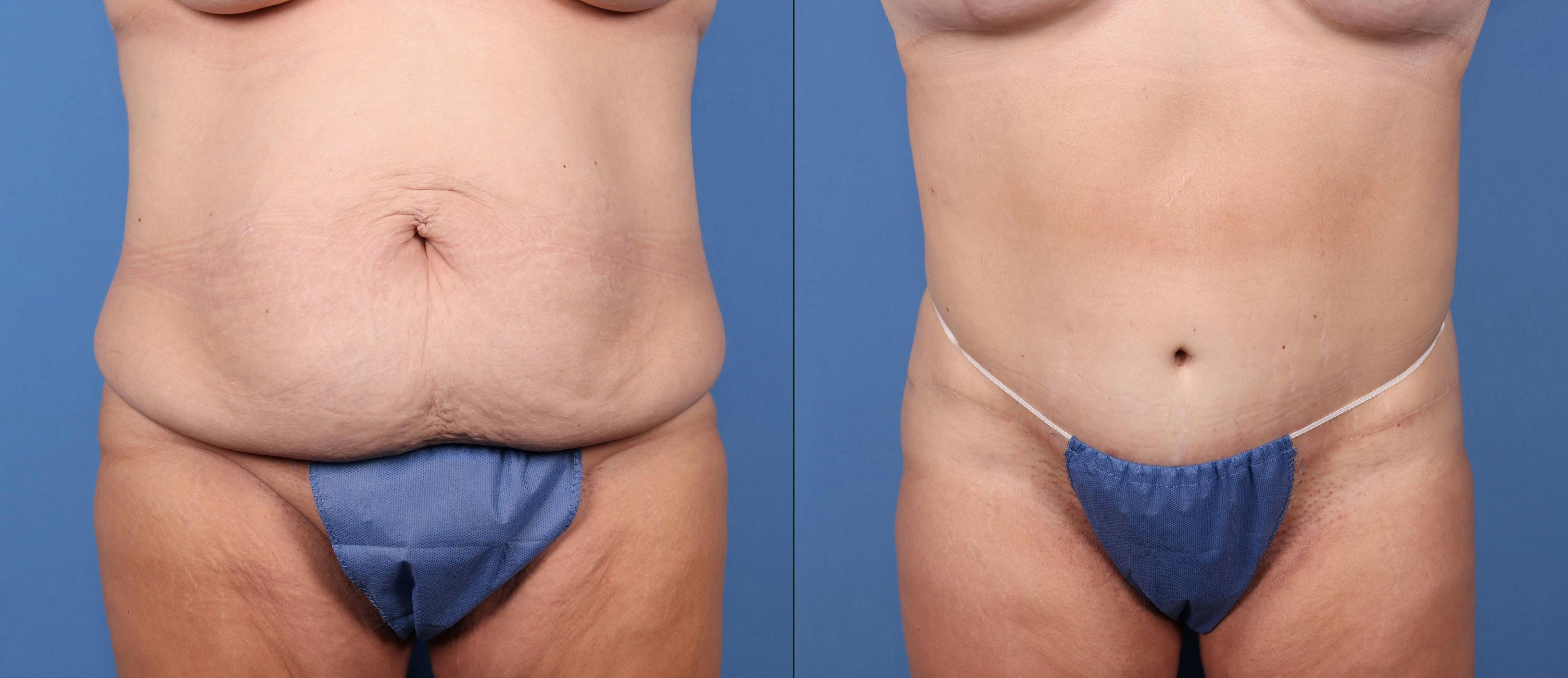 Liposuction