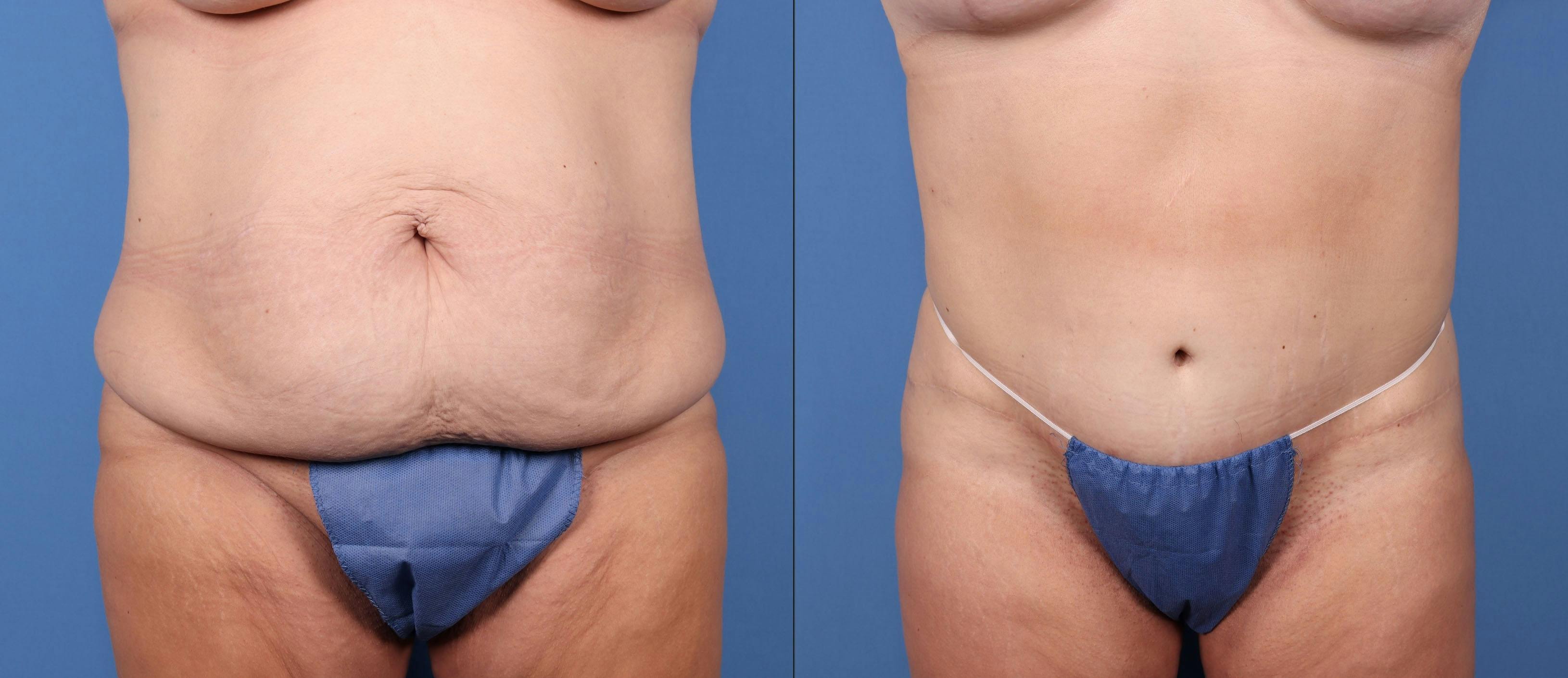 Abdomen Before & After Gallery - Patient 149385201 - Image 1