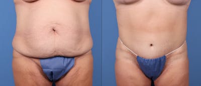 Tummy Tuck Before & After Gallery - Patient 149236575 - Image 1