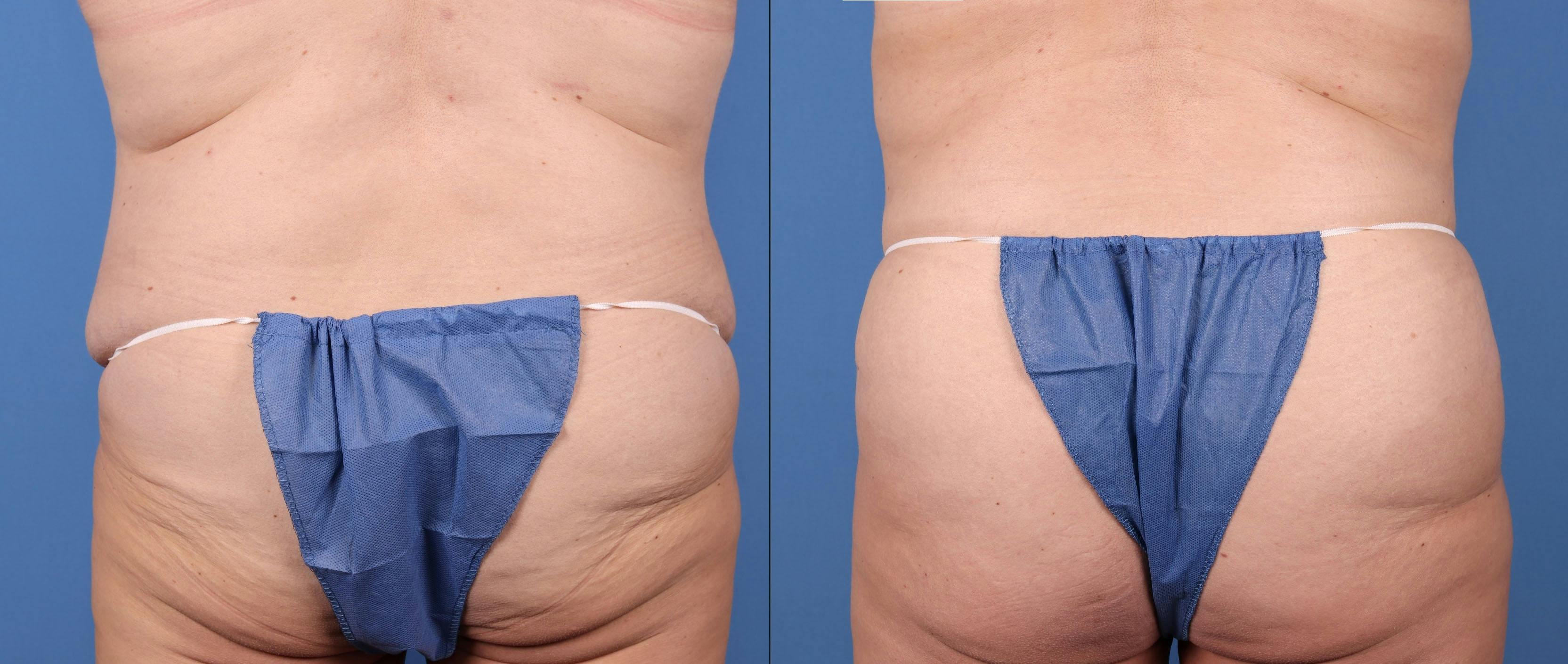 Abdomen Before & After Gallery - Patient 149385201 - Image 2