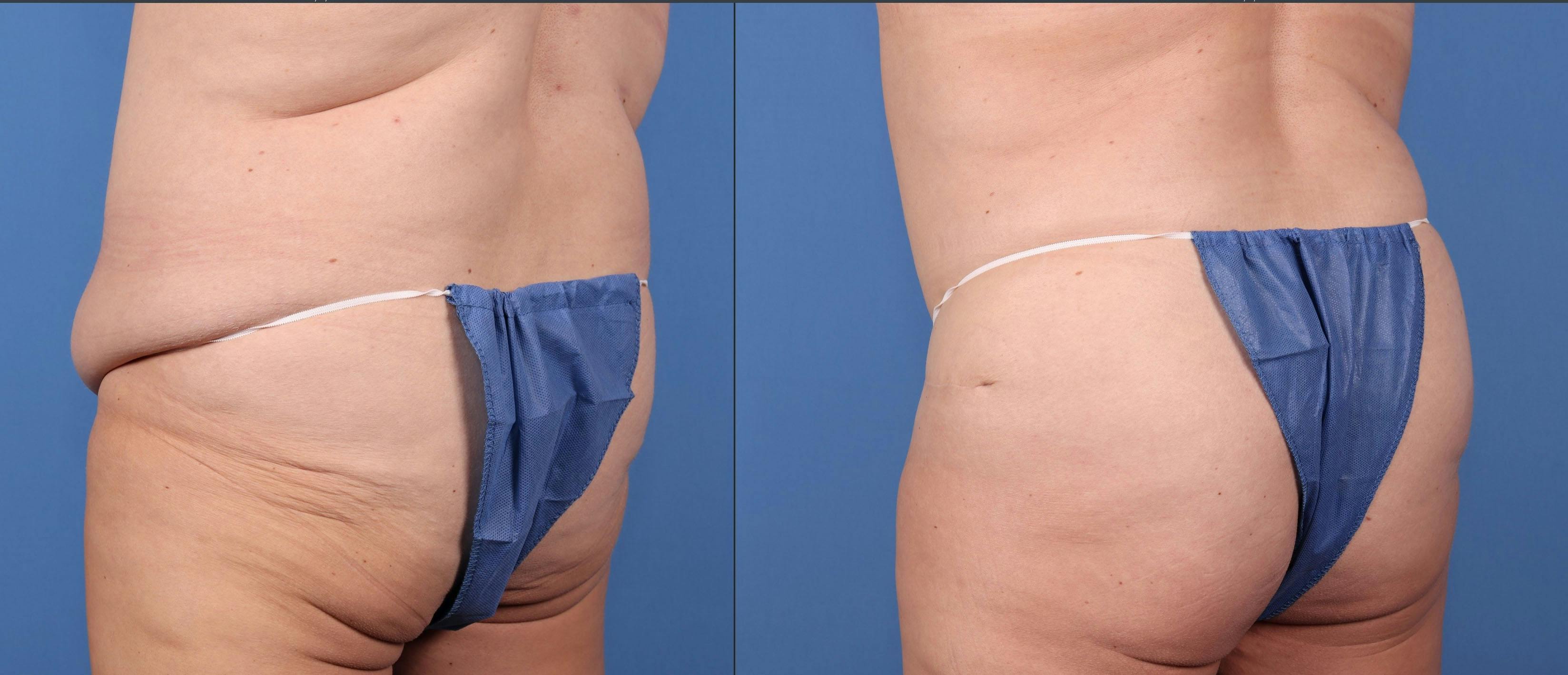 Abdomen Before & After Gallery - Patient 149385201 - Image 3
