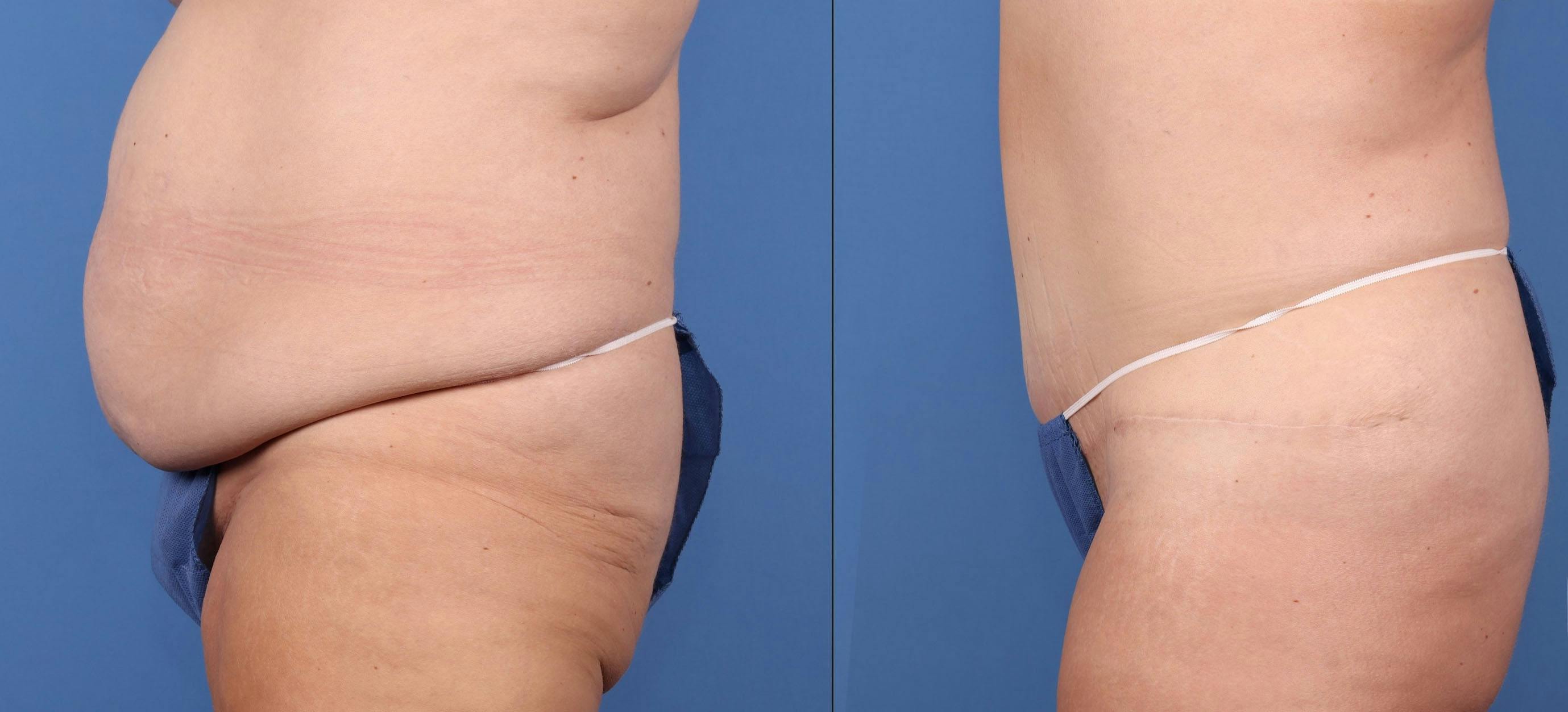 Abdomen Before & After Gallery - Patient 149385201 - Image 4