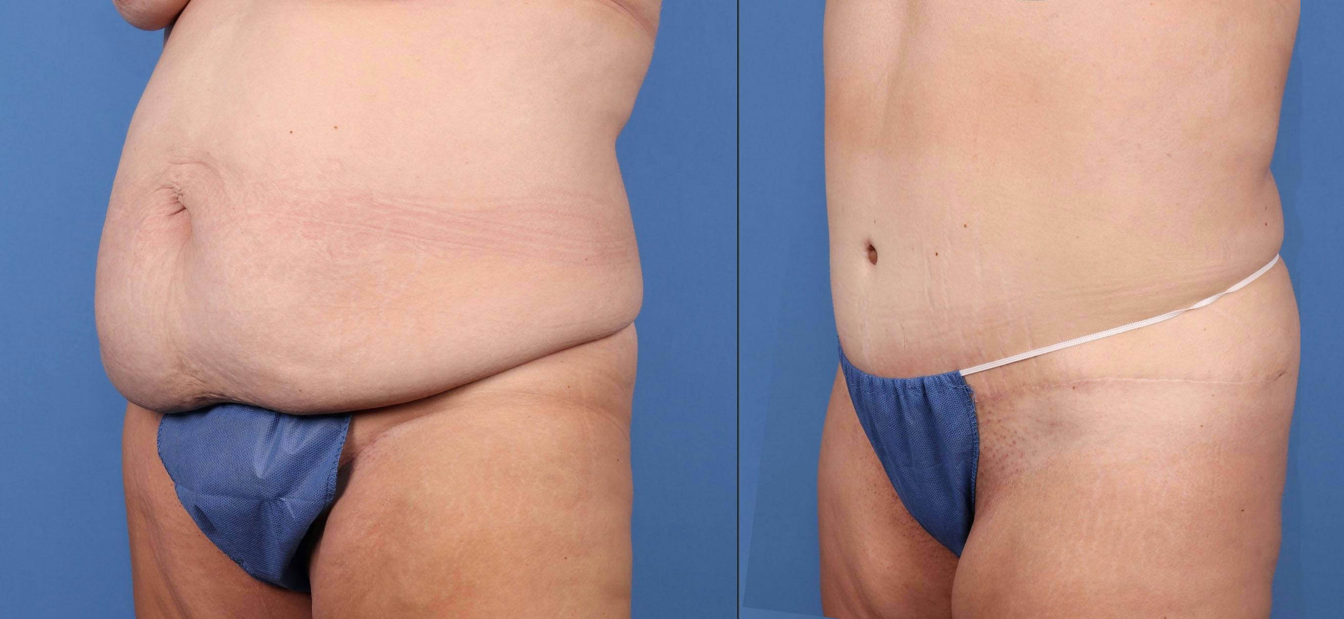 Tummy Tuck Before & After Gallery - Patient 149236575 - Image 5