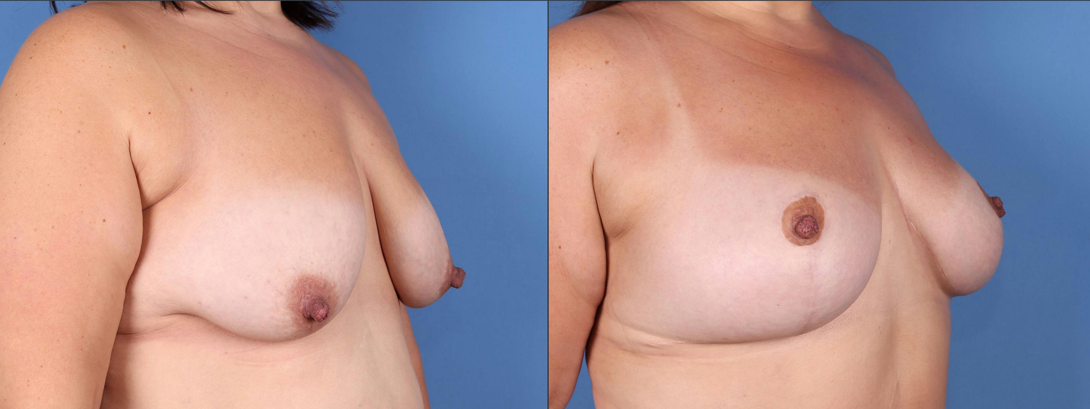 Breast Lift Before & After Gallery - Patient 149236580 - Image 2