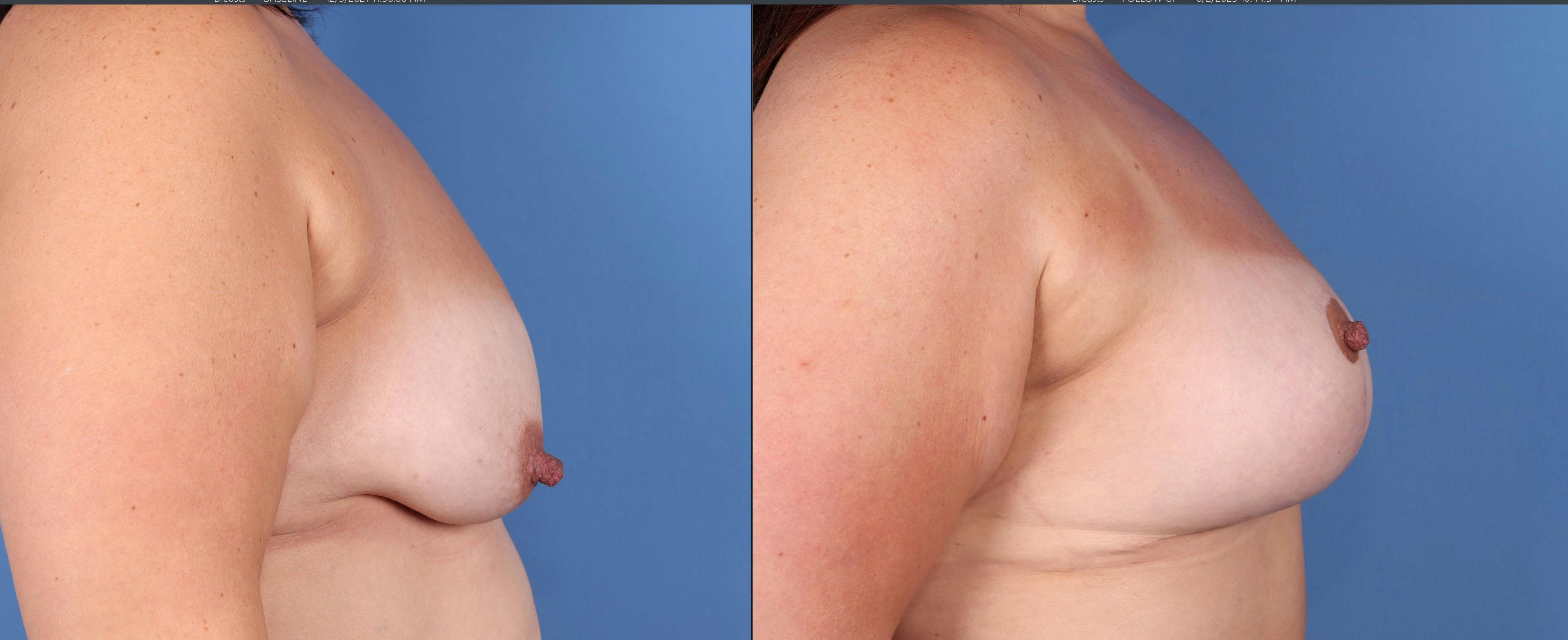Breast Lift Before & After Gallery - Patient 149236580 - Image 3