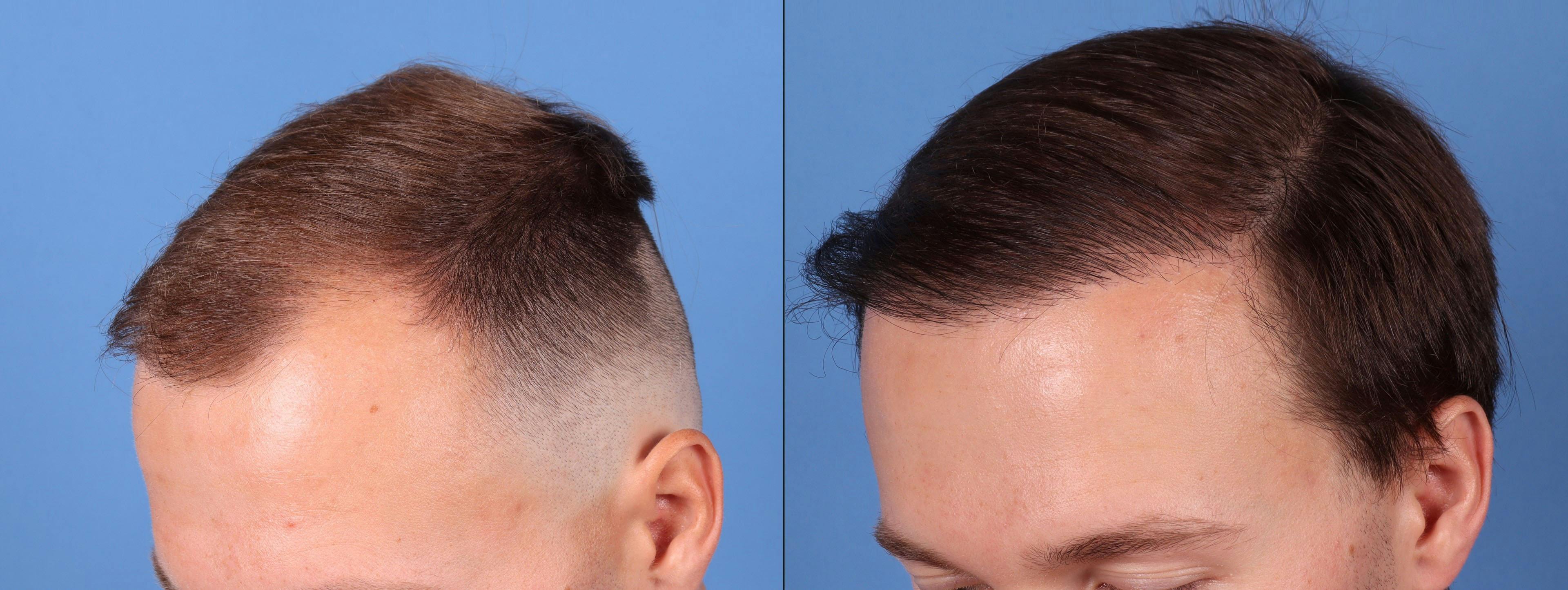 NeoGraft Hair Restoration Before & After Gallery - Patient 149283901 - Image 5