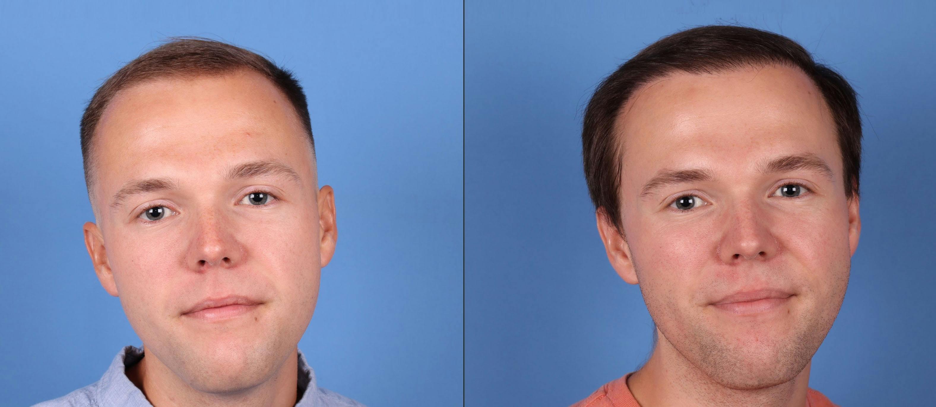 NeoGraft Hair Restoration Before & After Gallery - Patient 149283901 - Image 2
