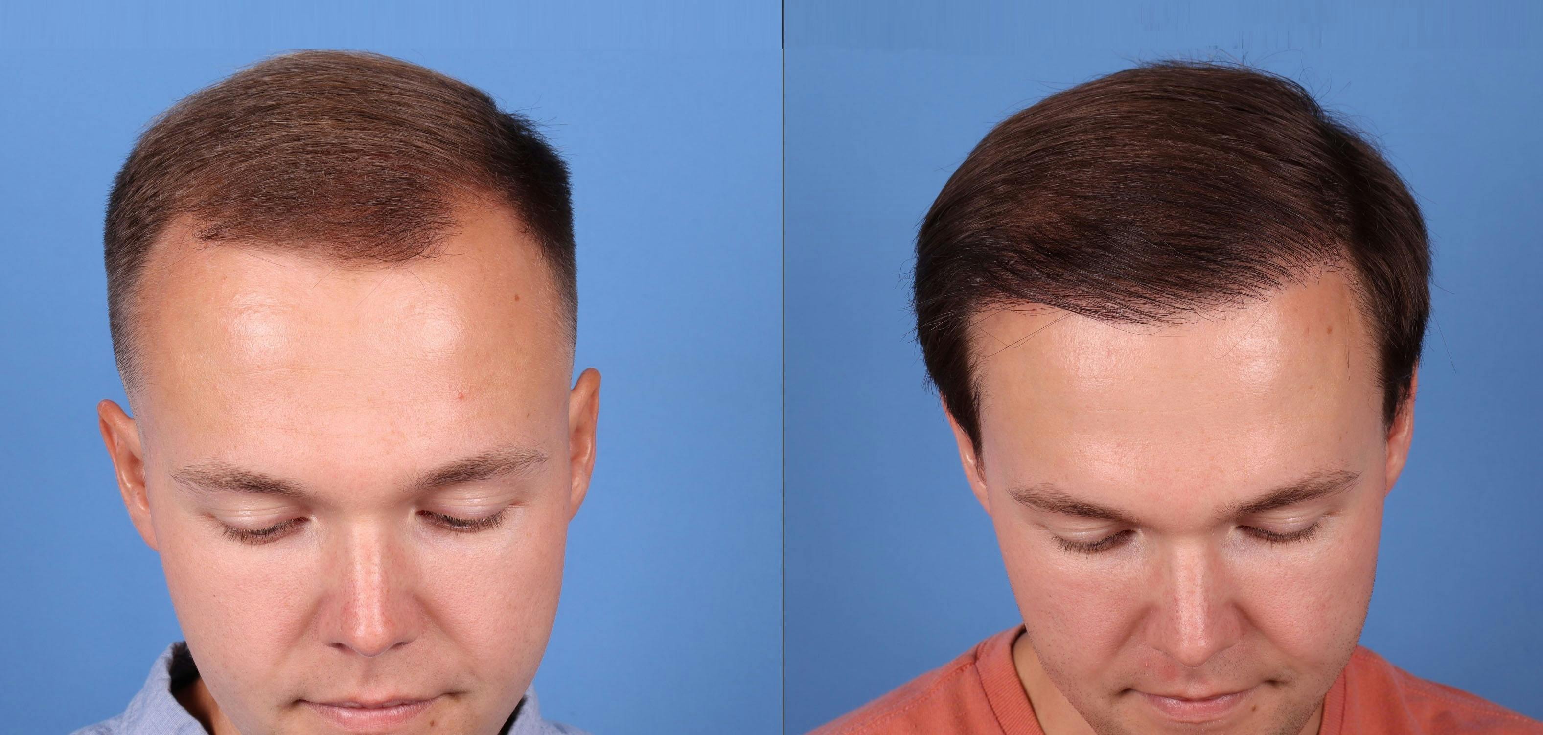NeoGraft Hair Restoration Before & After Gallery - Patient 149283901 - Image 1