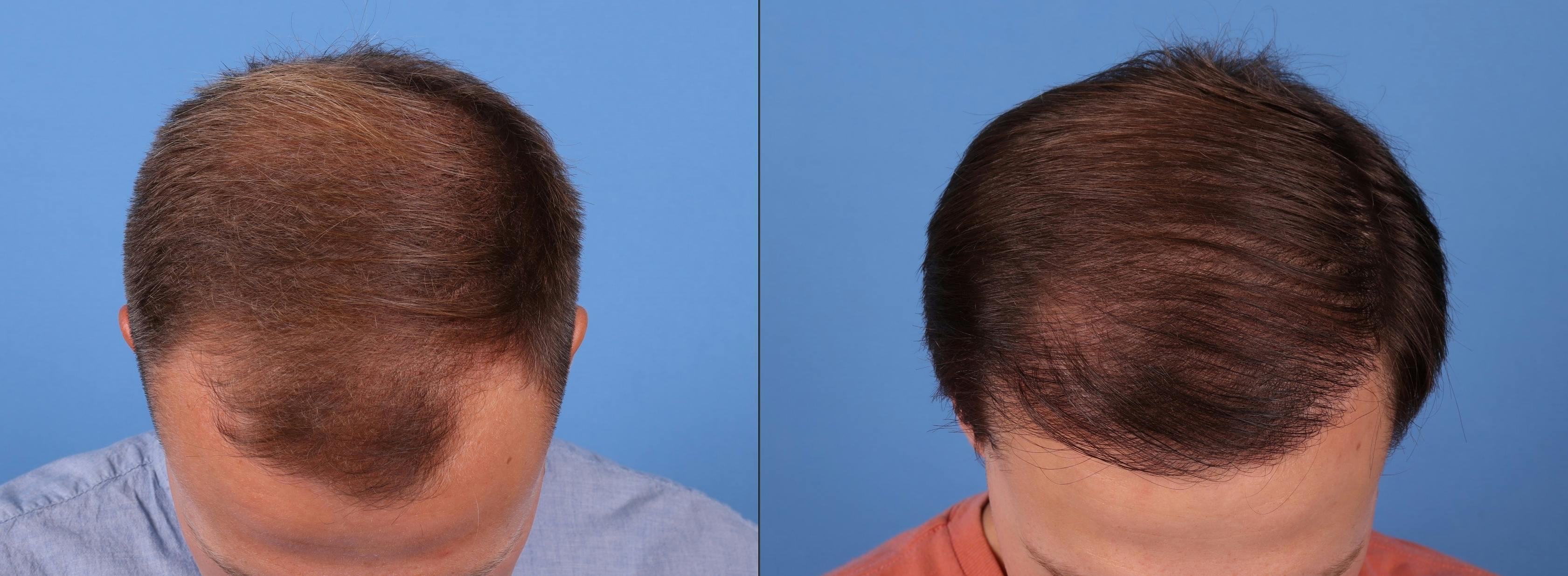 NeoGraft Hair Restoration Before & After Gallery - Patient 149283901 - Image 3