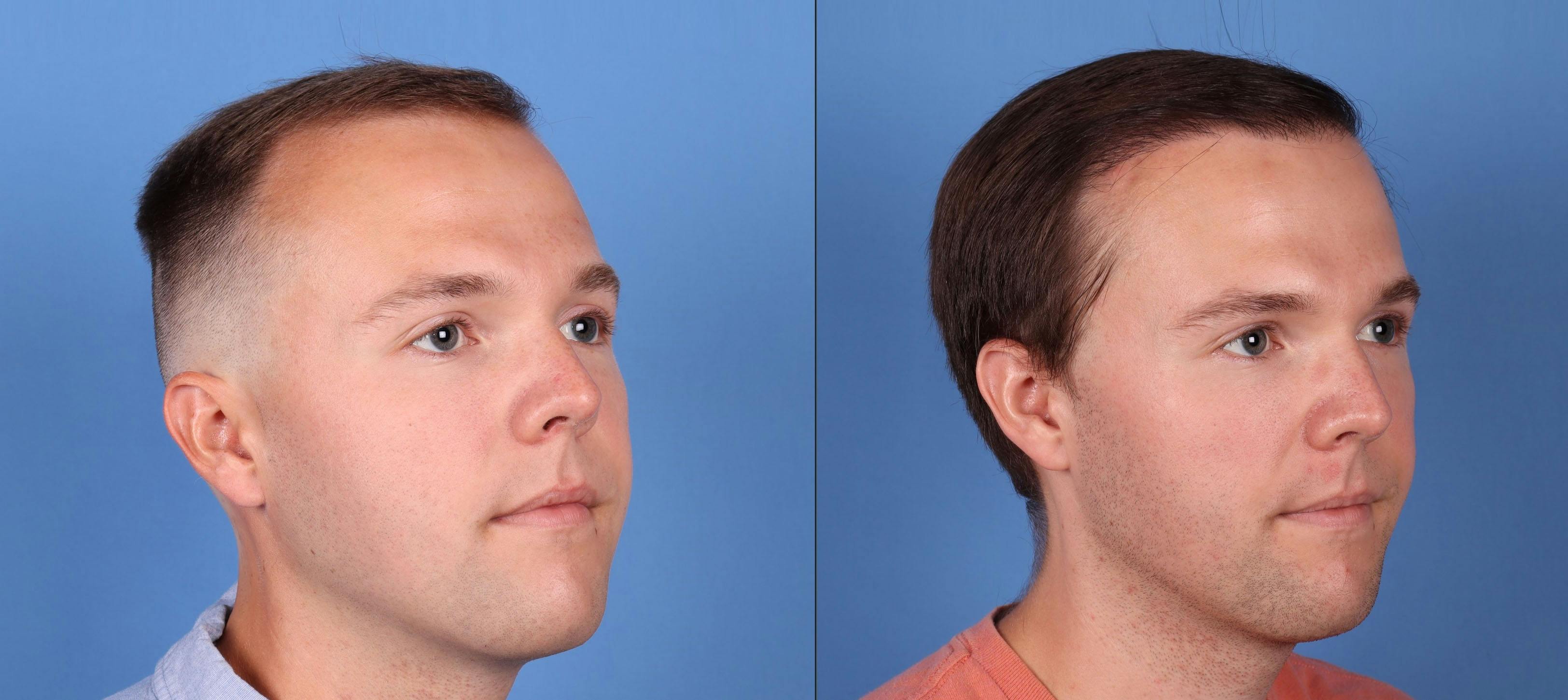 NeoGraft Hair Restoration Before & After Gallery - Patient 149283901 - Image 4