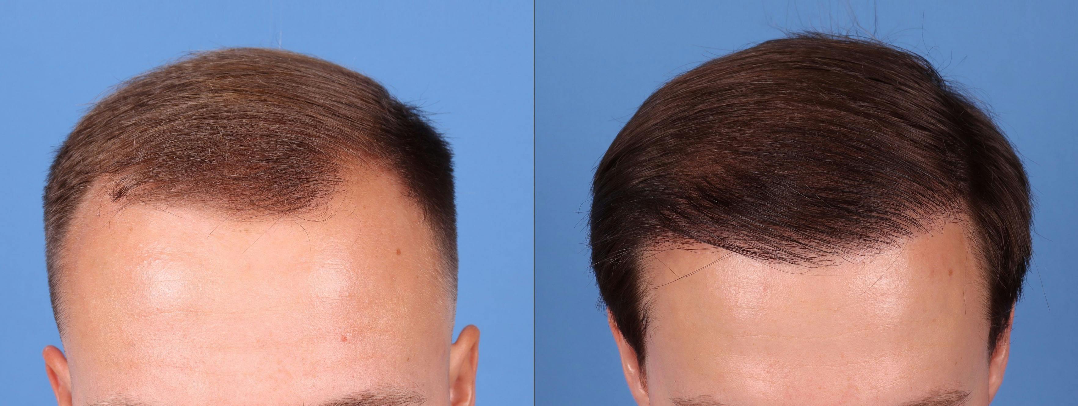 NeoGraft Hair Restoration Before & After Gallery - Patient 149283901 - Image 6