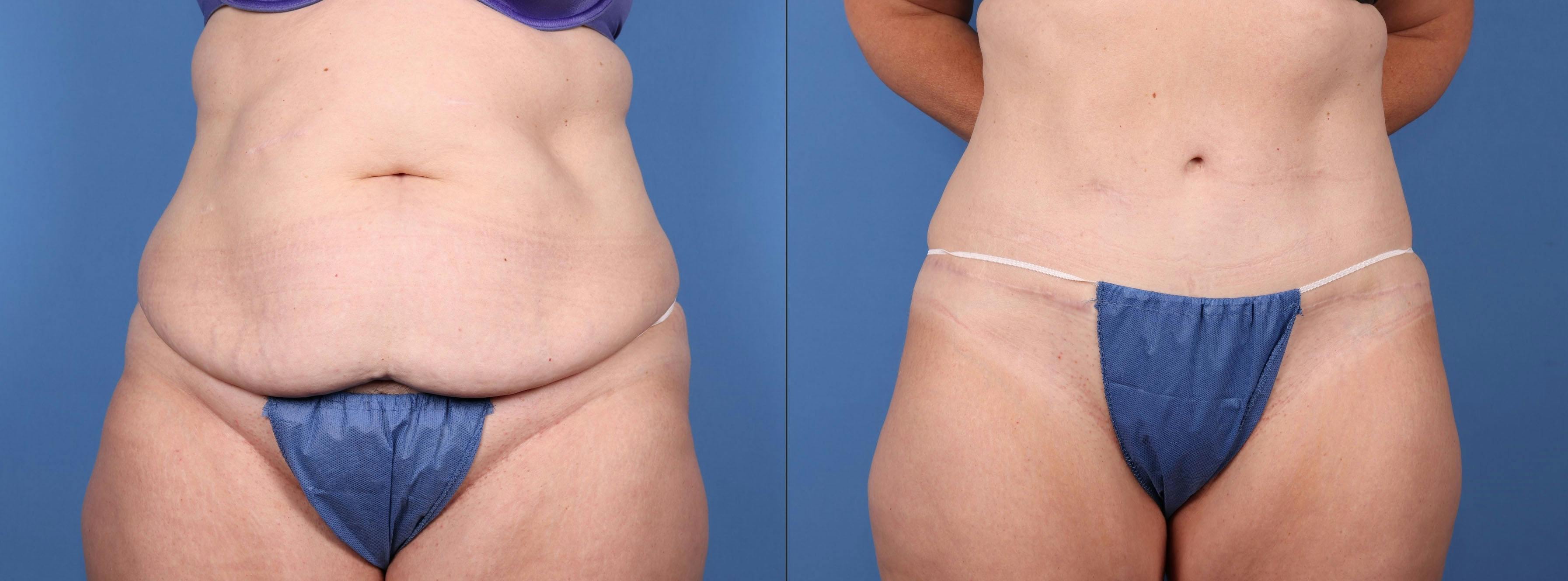 Abdomen Before & After Gallery - Patient 149385200 - Image 1