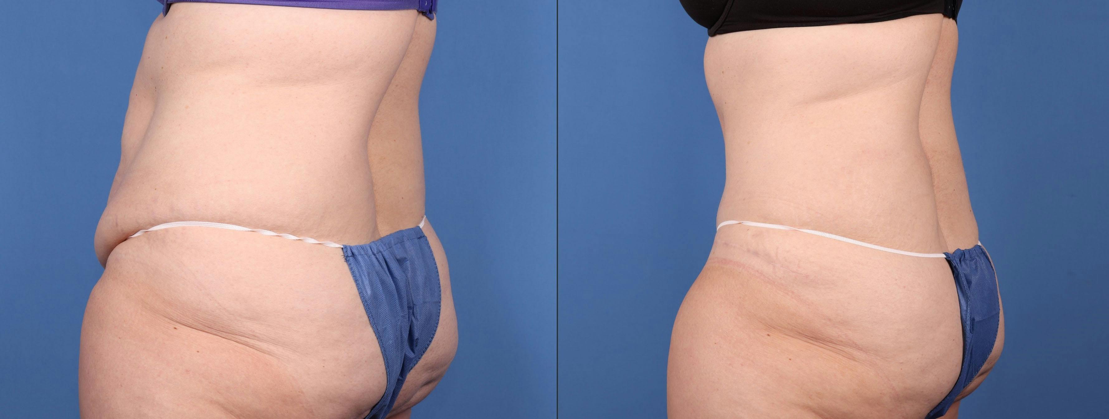 Abdomen Before & After Gallery - Patient 149385200 - Image 4
