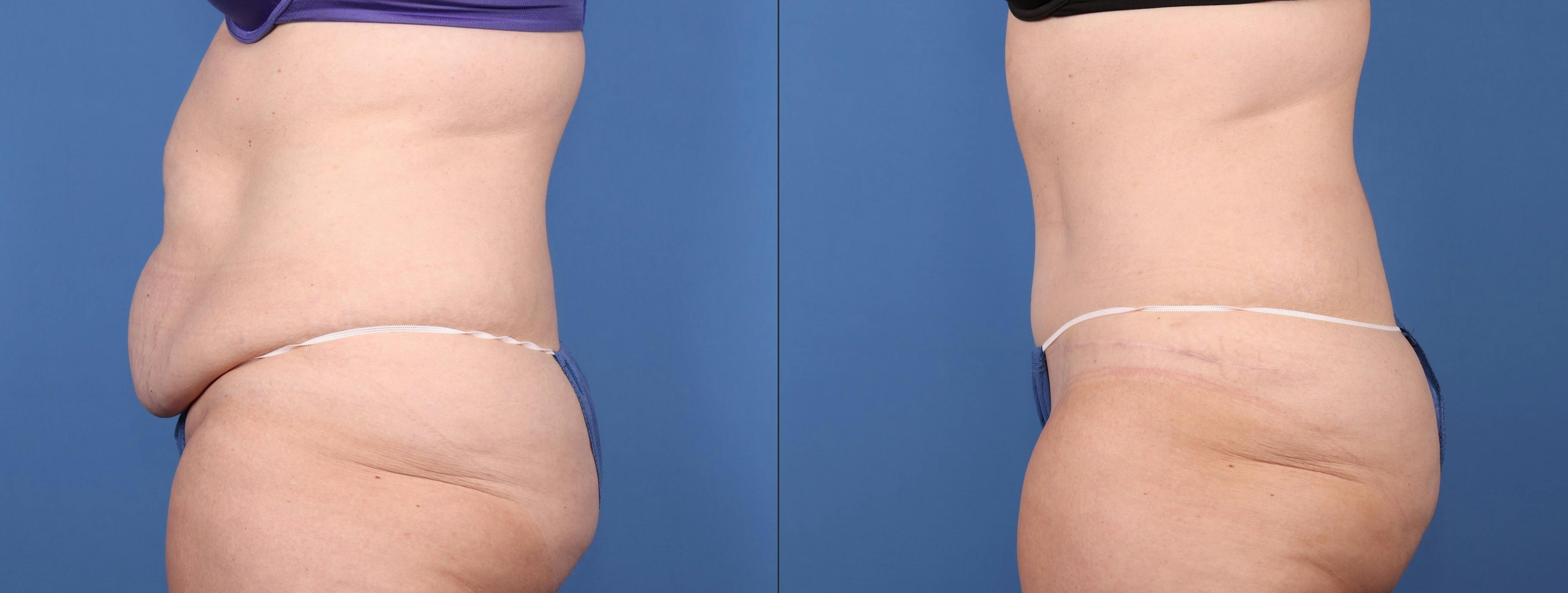 Abdomen Before & After Gallery - Patient 149385200 - Image 3