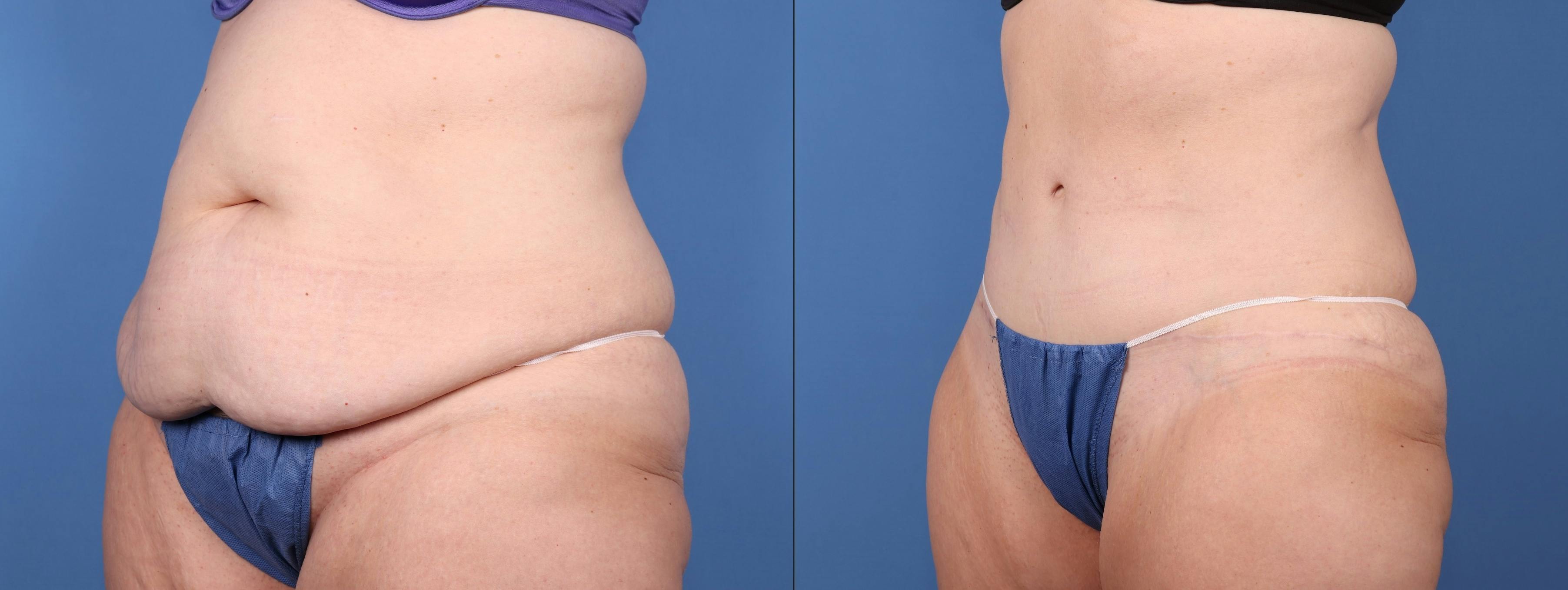 Abdomen Before & After Gallery - Patient 149385200 - Image 2