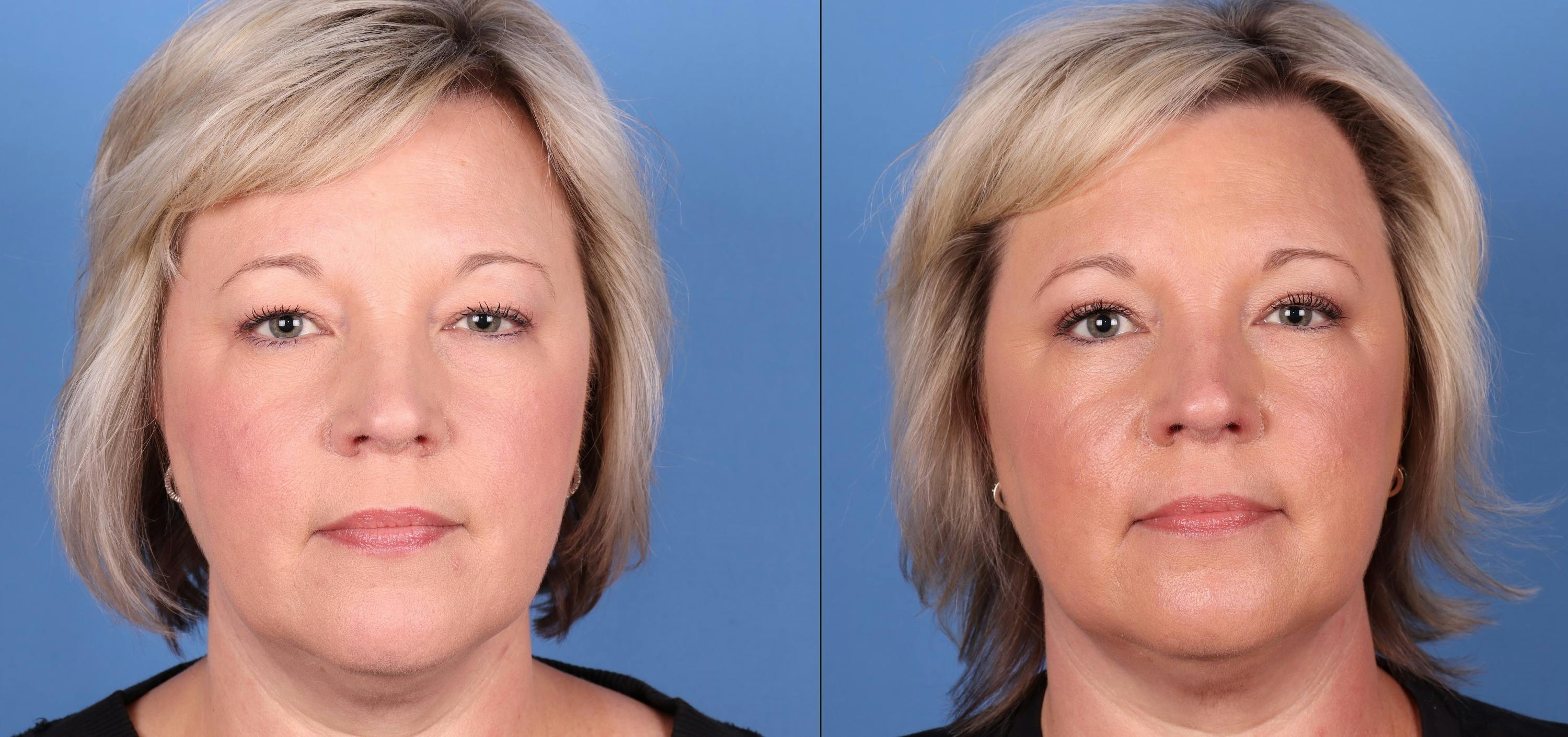 Eyelid Surgery (Upper Blepharoplasty) Before & After Gallery - Patient 149283935 - Image 1