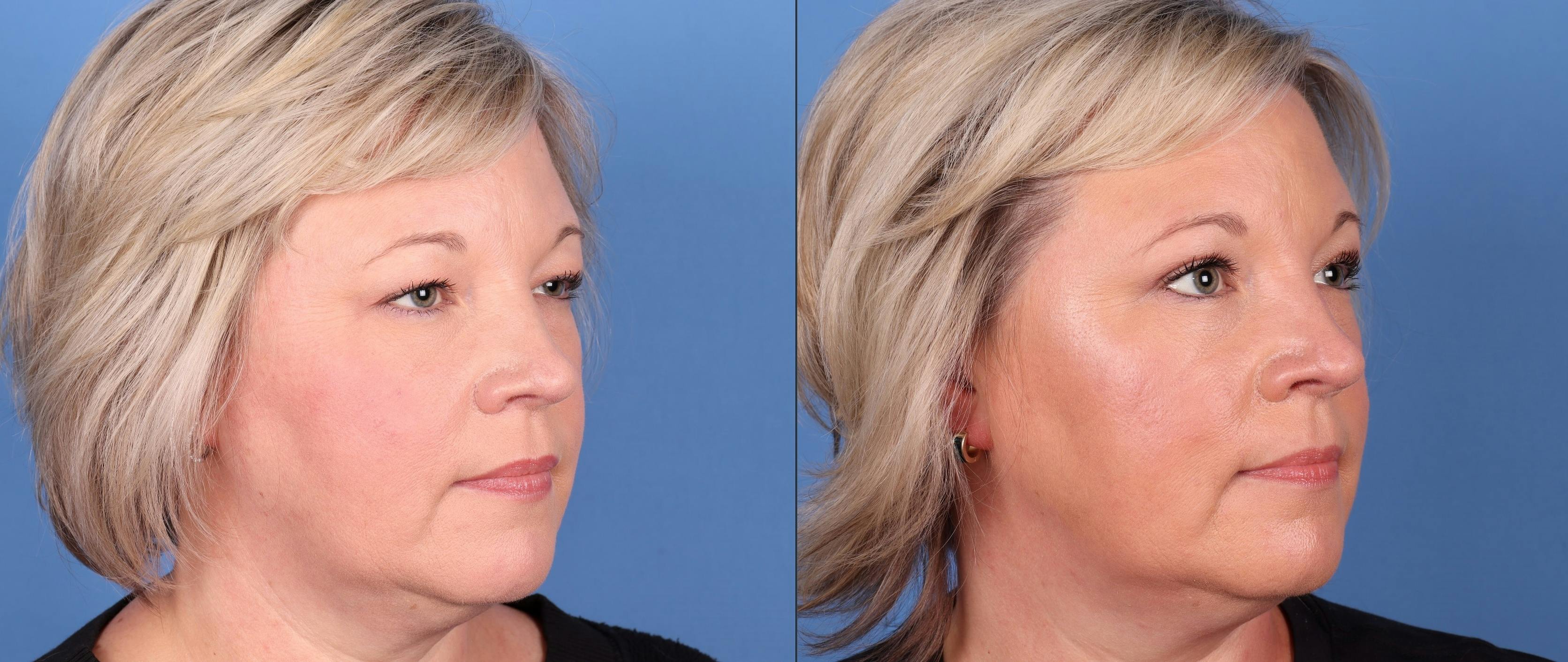 Eyelid Surgery (Upper Blepharoplasty) Before & After Gallery - Patient 149283935 - Image 2