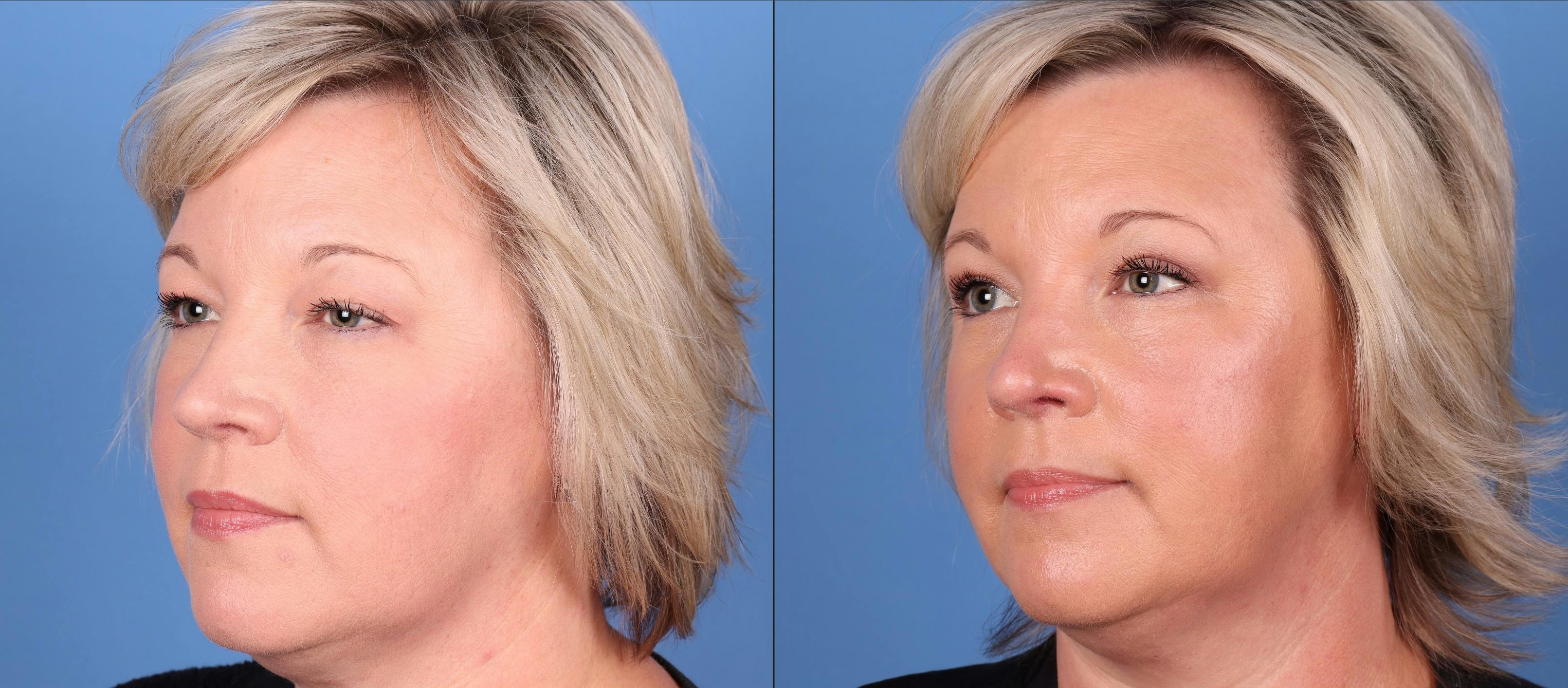 Eyelid Surgery (Upper Blepharoplasty) Before & After Gallery - Patient 149283935 - Image 3