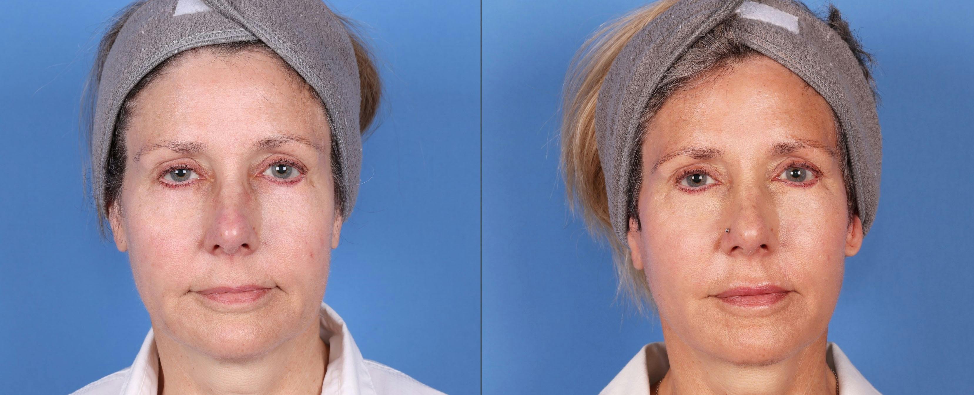 Face Lift Before & After Gallery - Patient 149283945 - Image 1