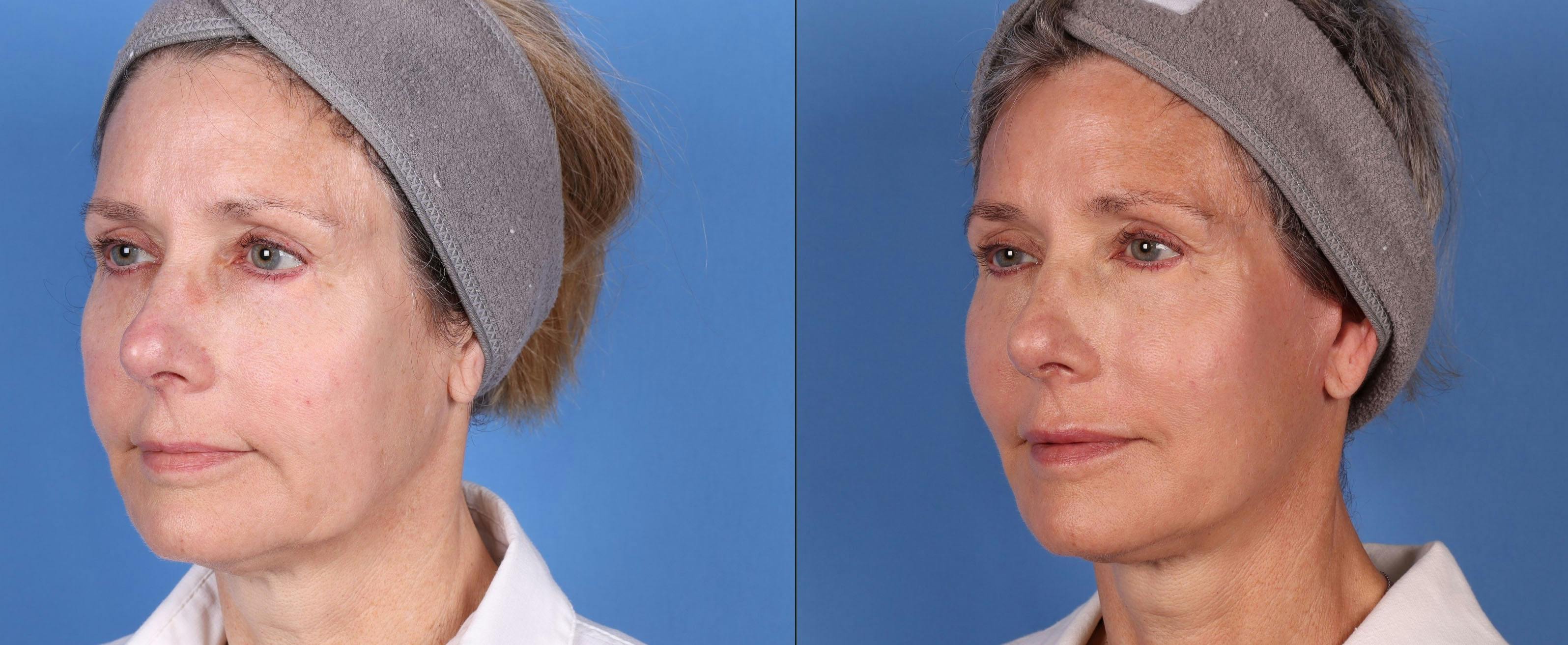 Face Lift Before & After Gallery - Patient 149283945 - Image 2