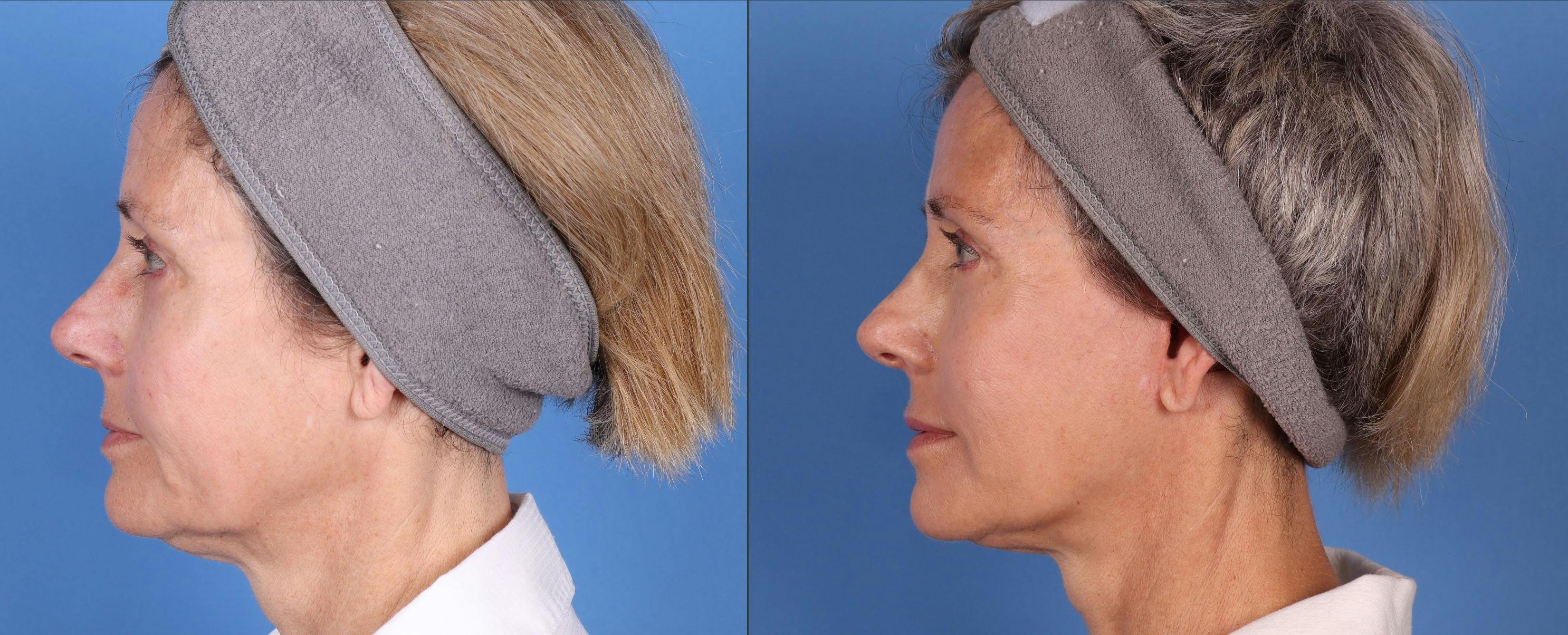 Face Lift Before & After Gallery - Patient 149283945 - Image 3