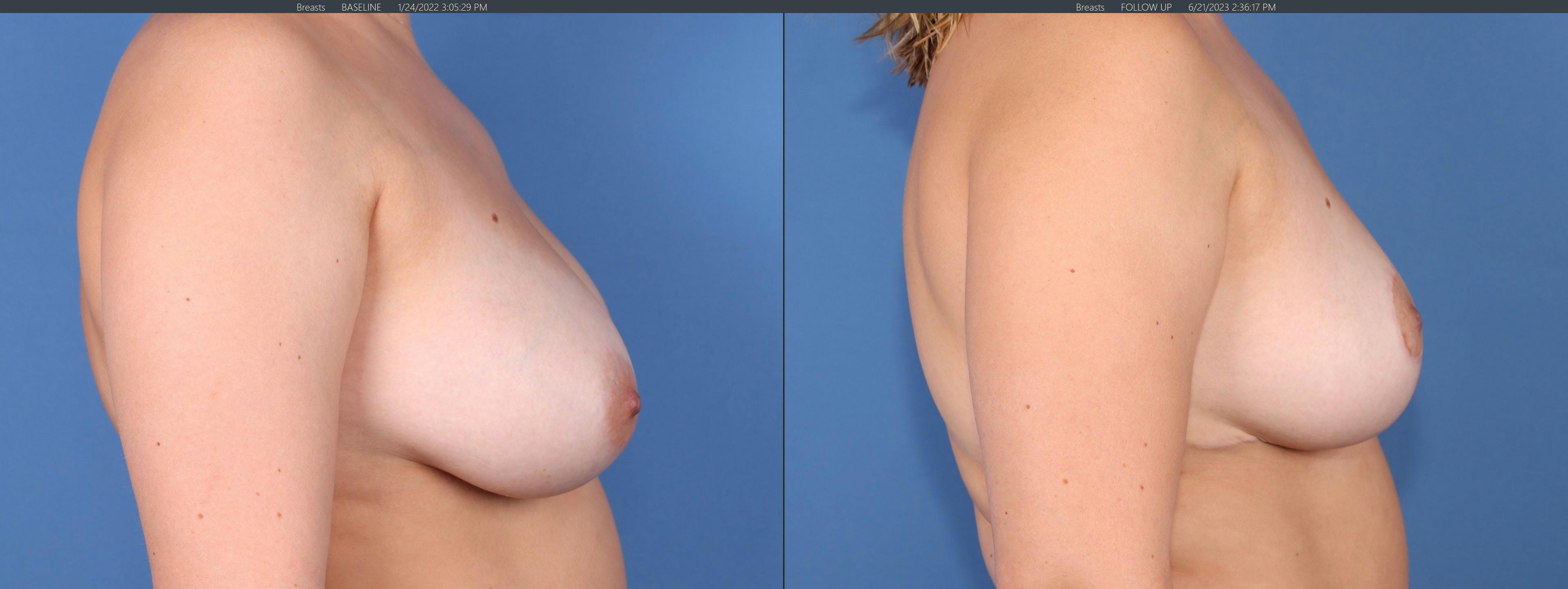 Breast Reduction Before & After Gallery - Patient 149283957 - Image 3