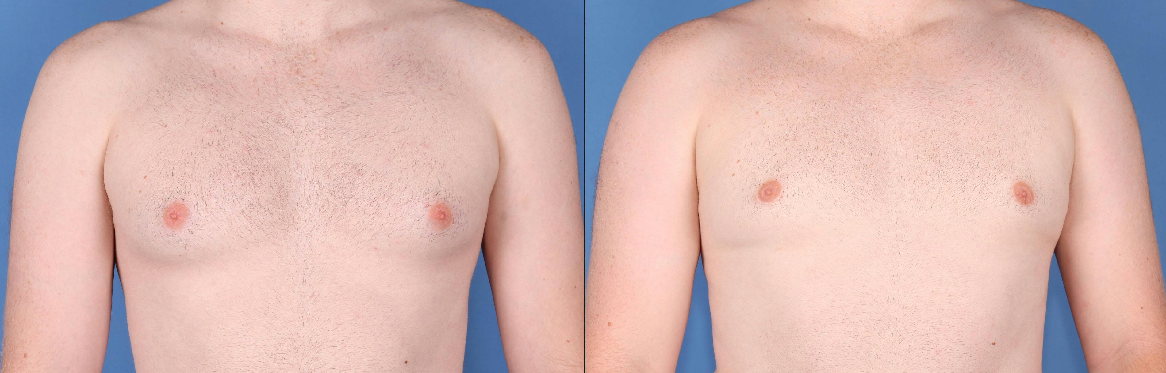 Male Breast Reduction Before & After Gallery - Patient 149283961 - Image 1