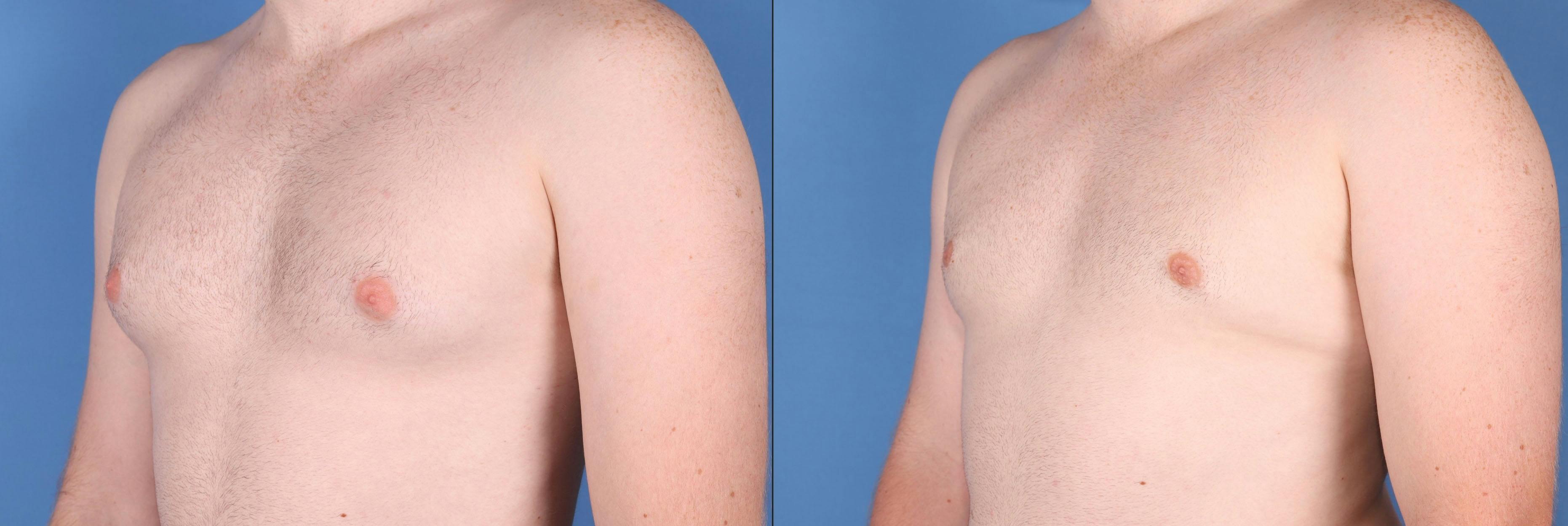 Male Breast Reduction Before & After Gallery - Patient 149283961 - Image 2