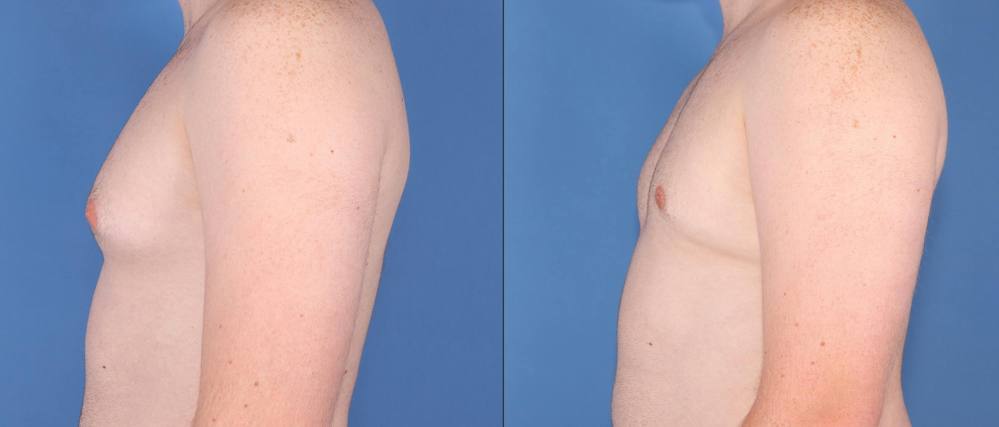 Male Breast Reduction Before & After Gallery - Patient 149283961 - Image 3