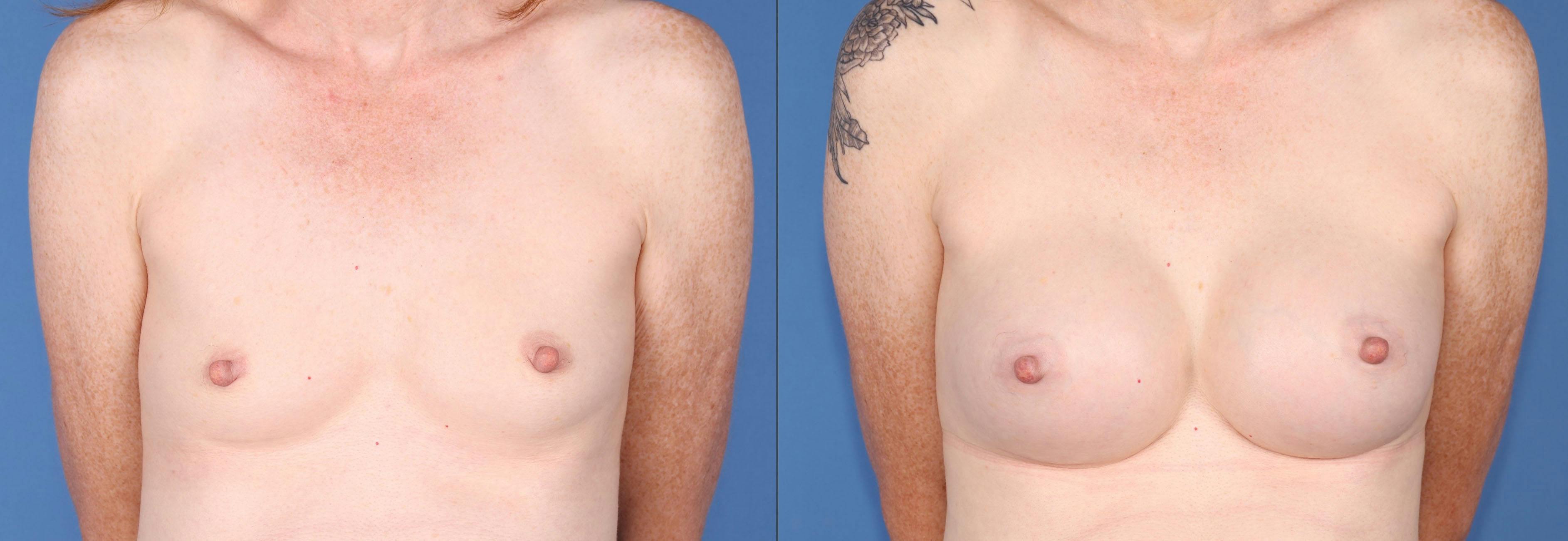 Breast Augmentation Before & After Gallery - Patient 149283970 - Image 1