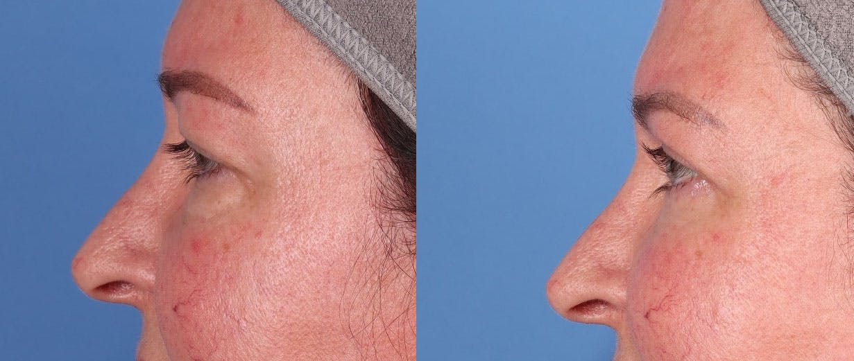 Eyelid Surgery (Blepharoplasty) Before & After Gallery - Patient 149384325 - Image 3