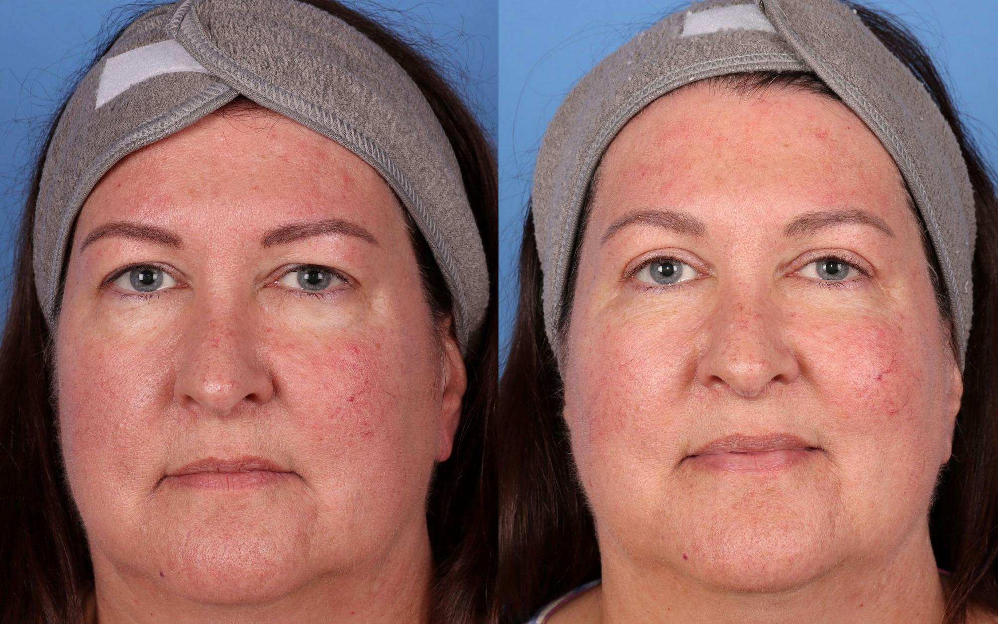 Eyelid Surgery (Blepharoplasty) Before & After Gallery - Patient 149384325 - Image 1