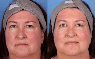 Eyelid Surgery (Upper & Lower Blepharoplasty) Before & After Gallery - Patient 227575 - Image 1
