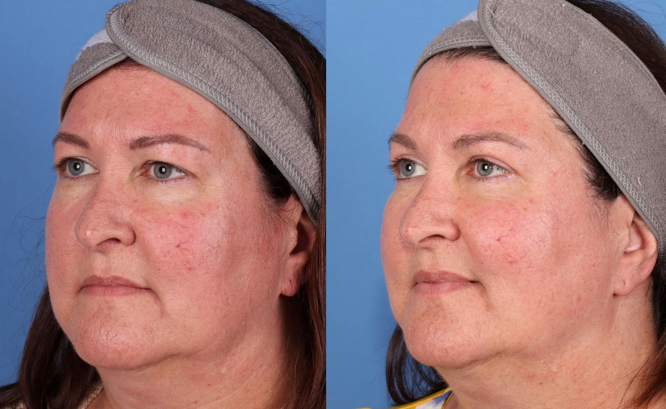 Eyelid Surgery (Blepharoplasty) Before & After Gallery - Patient 149384325 - Image 2