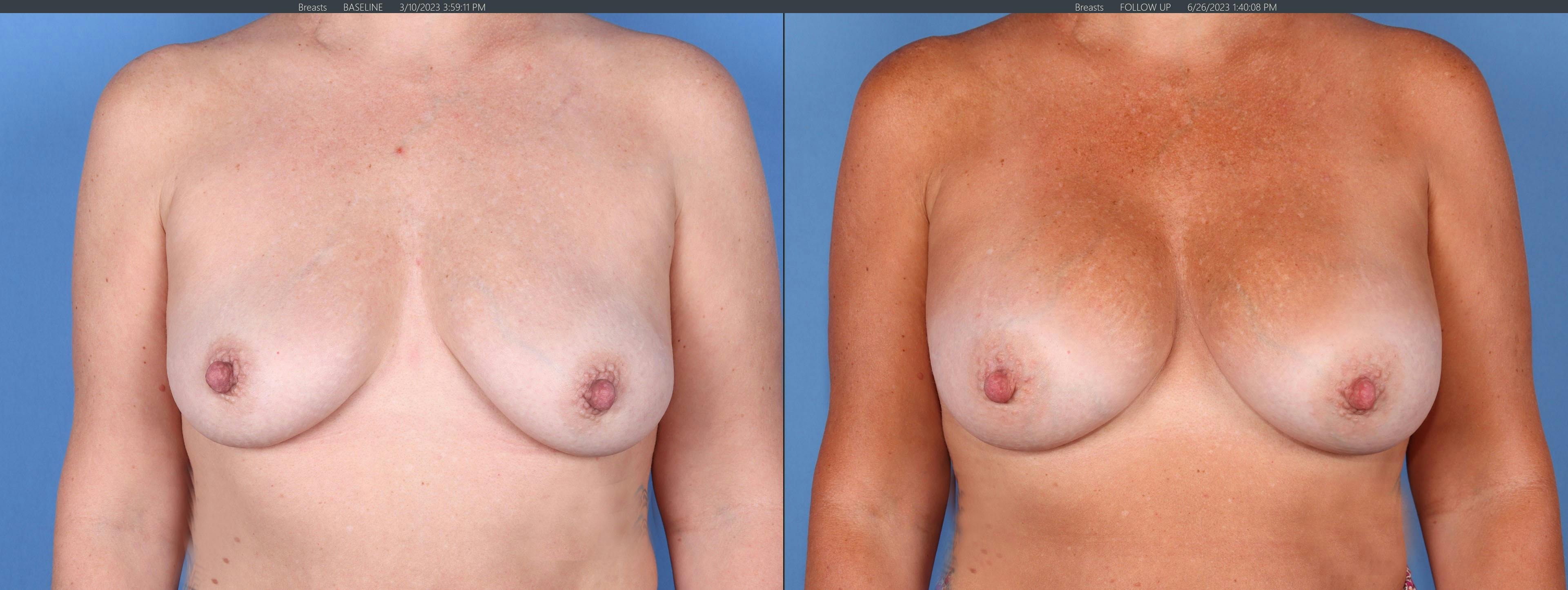 Breast Augmentation Before & After Gallery - Patient 149384328 - Image 1
