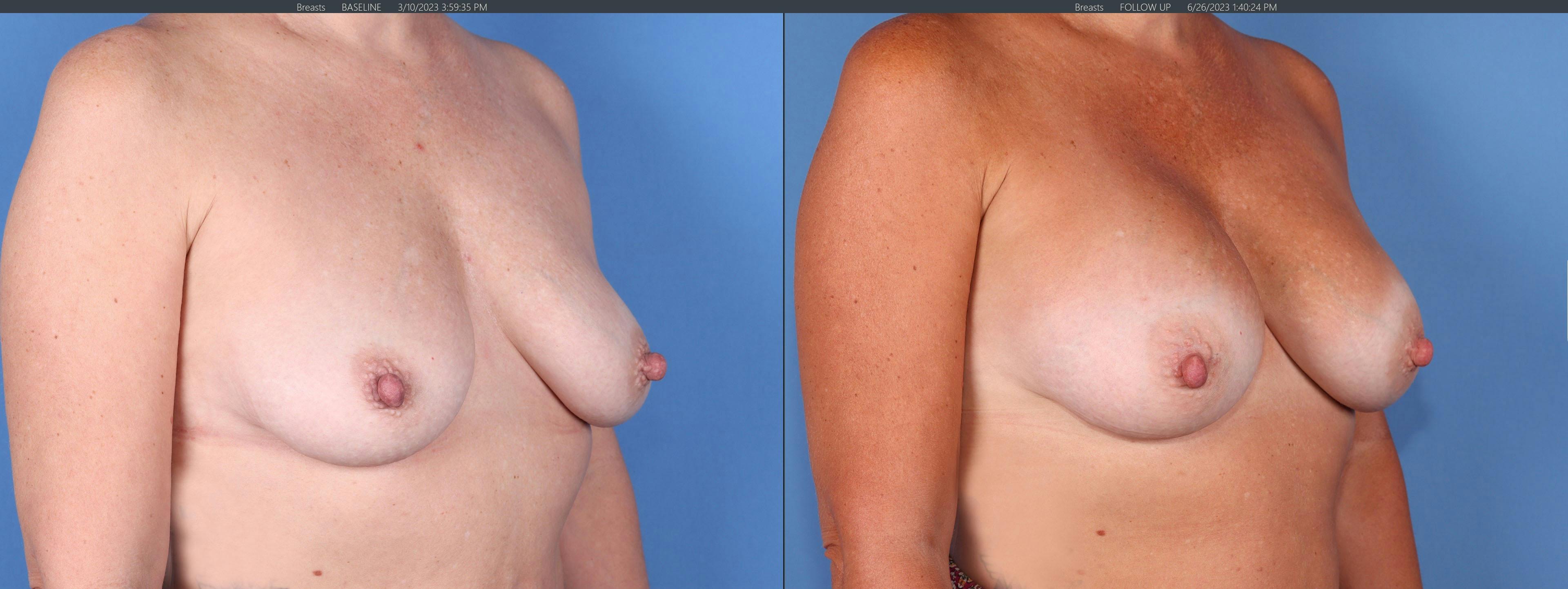 Breast Augmentation Before & After Gallery - Patient 149384328 - Image 2