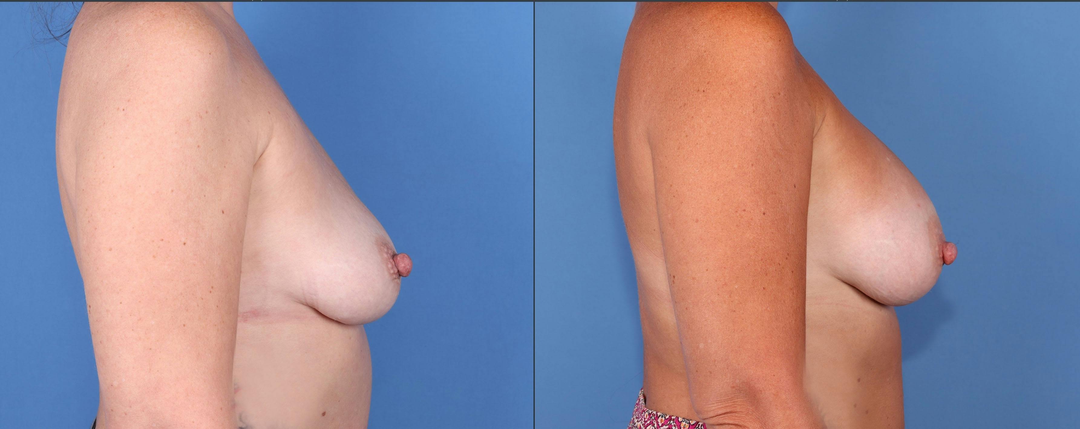 Breast Augmentation Before & After Gallery - Patient 149384328 - Image 3