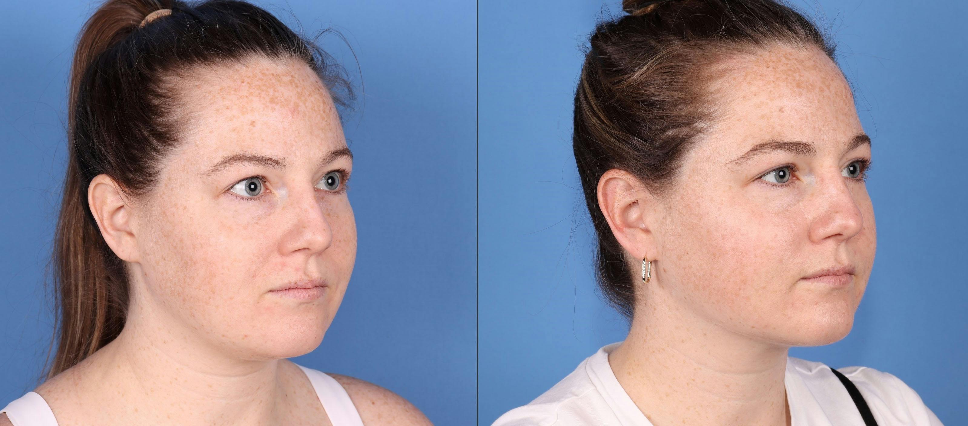 Face Before & After Gallery - Patient 149385105 - Image 1