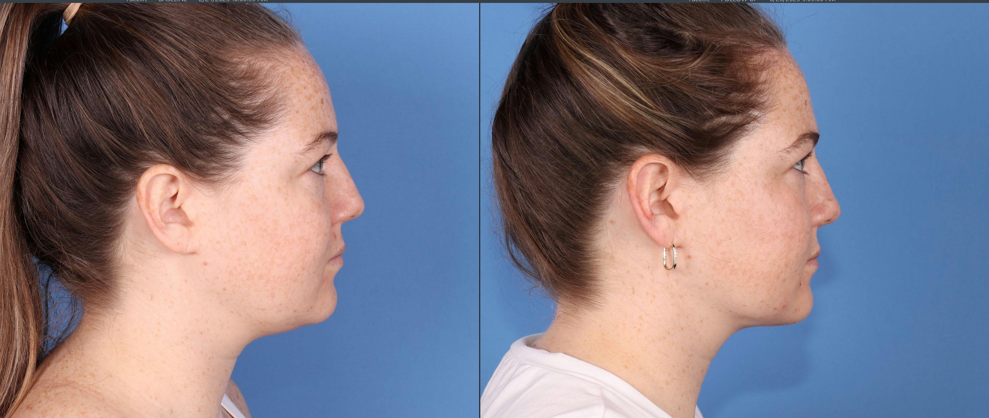 Face Before & After Gallery - Patient 149385105 - Image 2