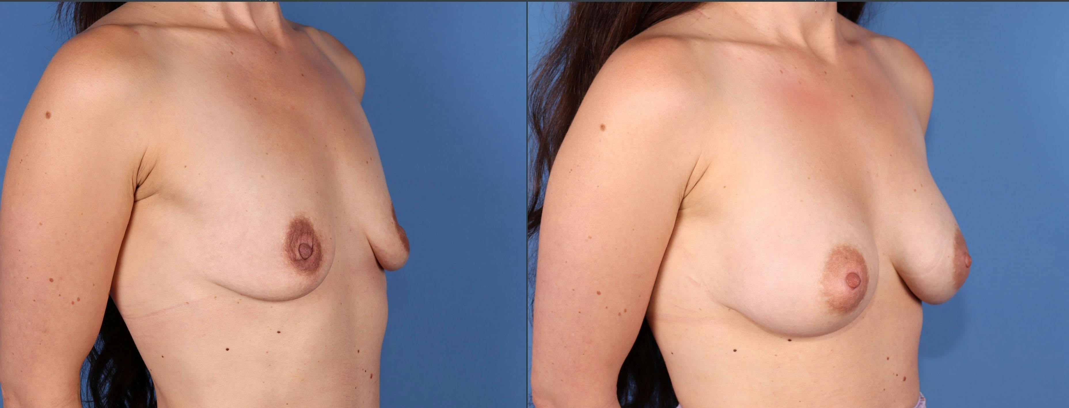 Breast Augmentation Before & After Gallery - Patient 149463896 - Image 2