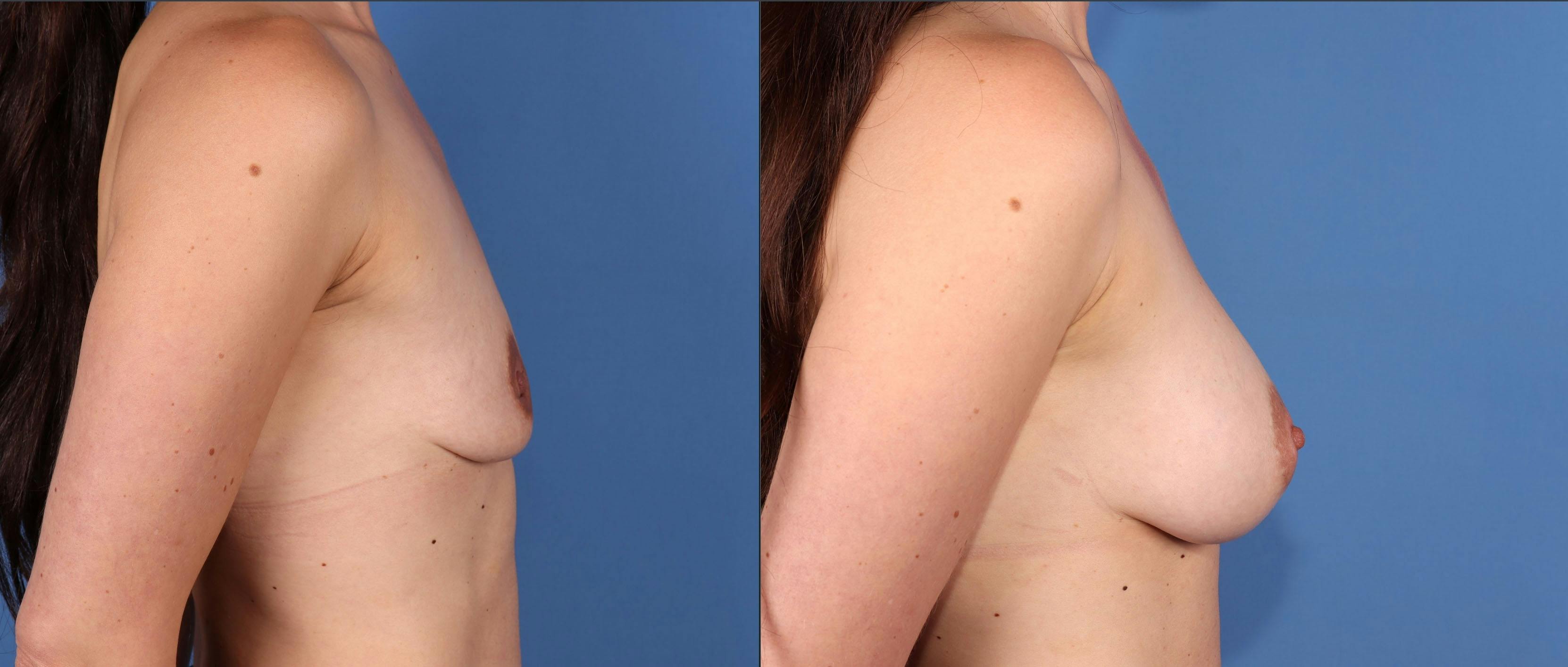 Breast Augmentation Before & After Gallery - Patient 149463896 - Image 3