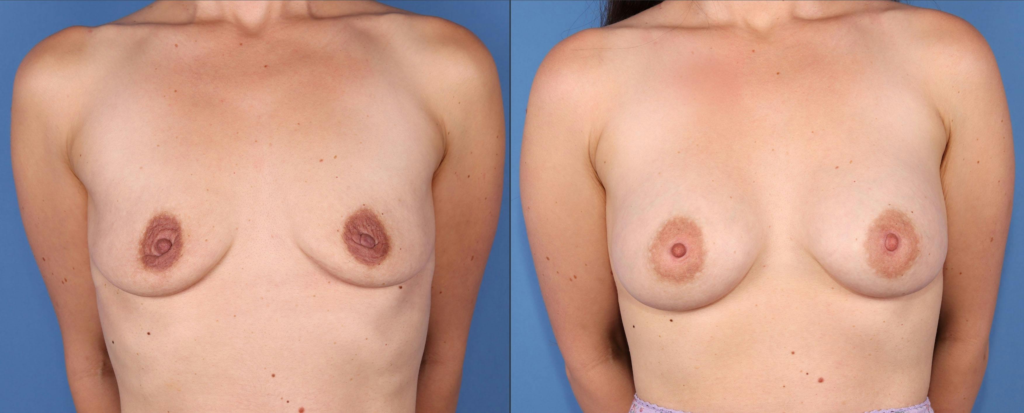 Breast Augmentation Before & After Gallery - Patient 149463896 - Image 1