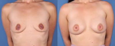 Breast Augmentation Before & After Gallery - Patient 149463896 - Image 1
