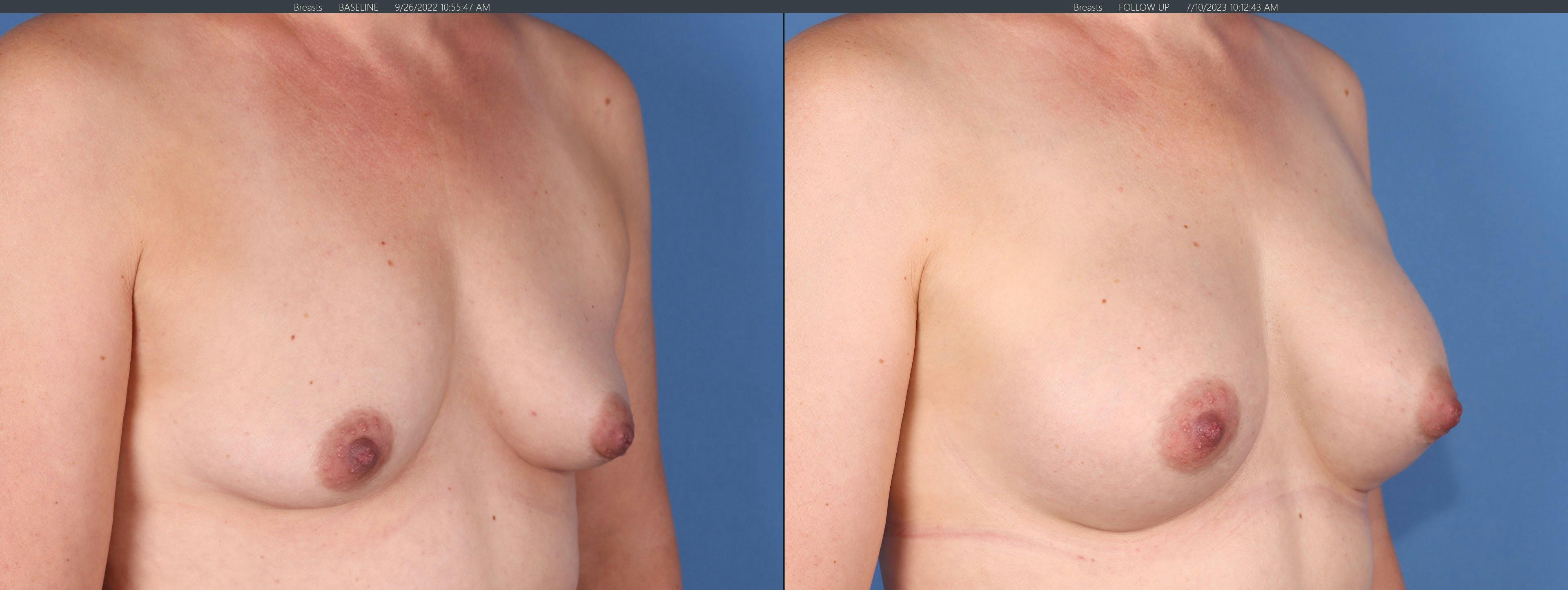 Breast Augmentation Before & After Gallery - Patient 152529557 - Image 2