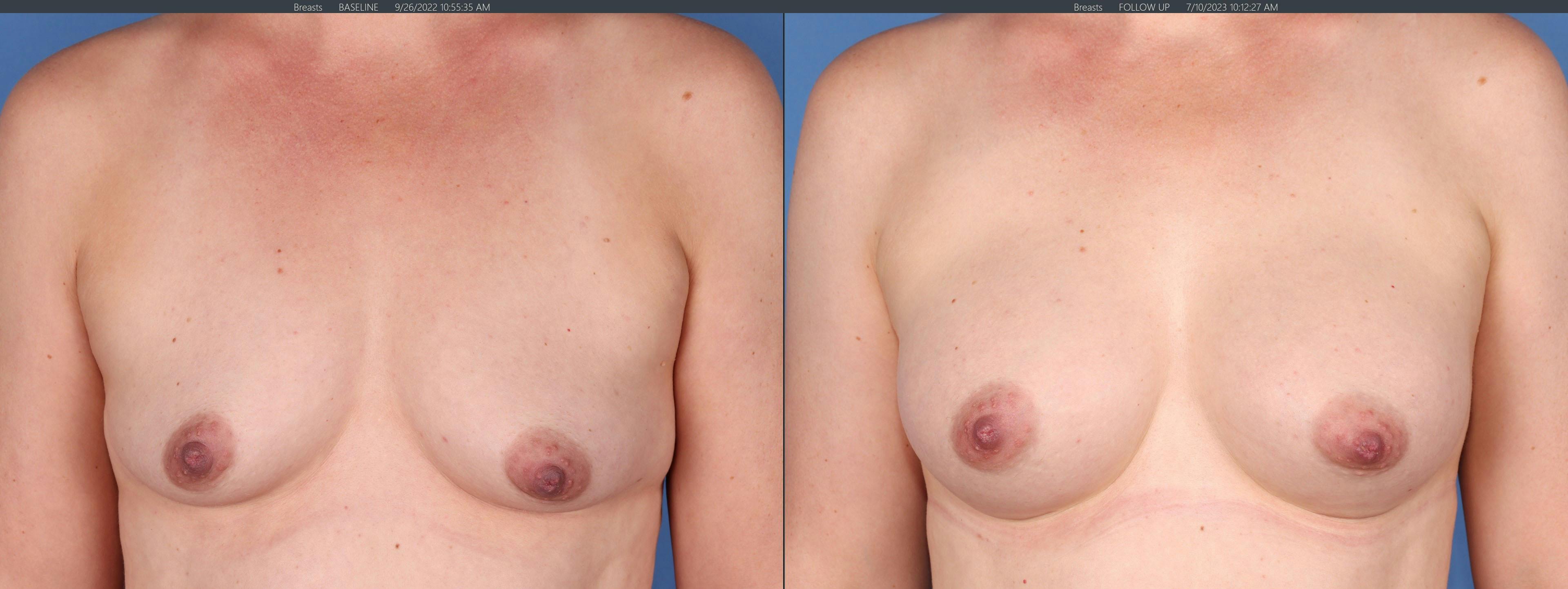 Breast Augmentation Before & After Gallery - Patient 152529557 - Image 1