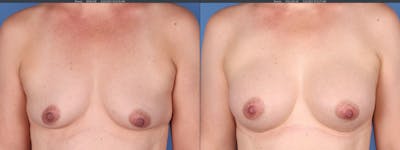 Breast Augmentation Before & After Gallery - Patient 152529557 - Image 1