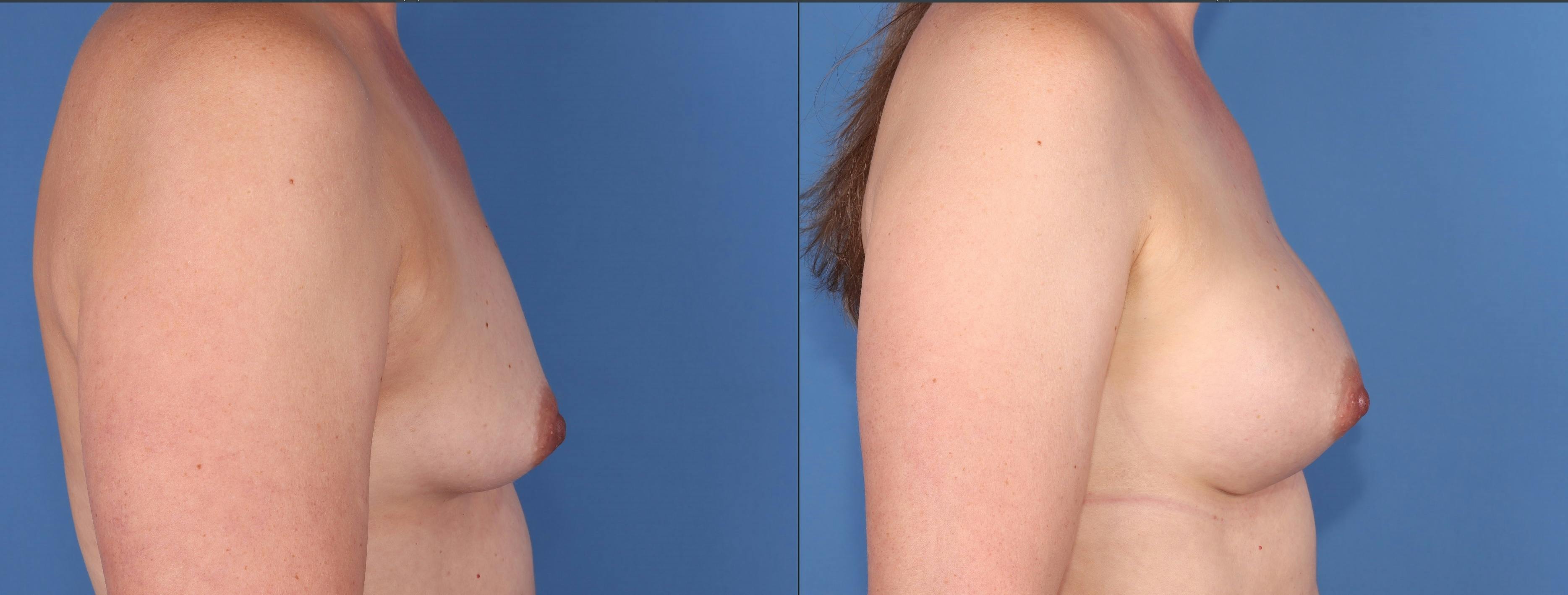 Breast Augmentation Before & After Gallery - Patient 152529557 - Image 3