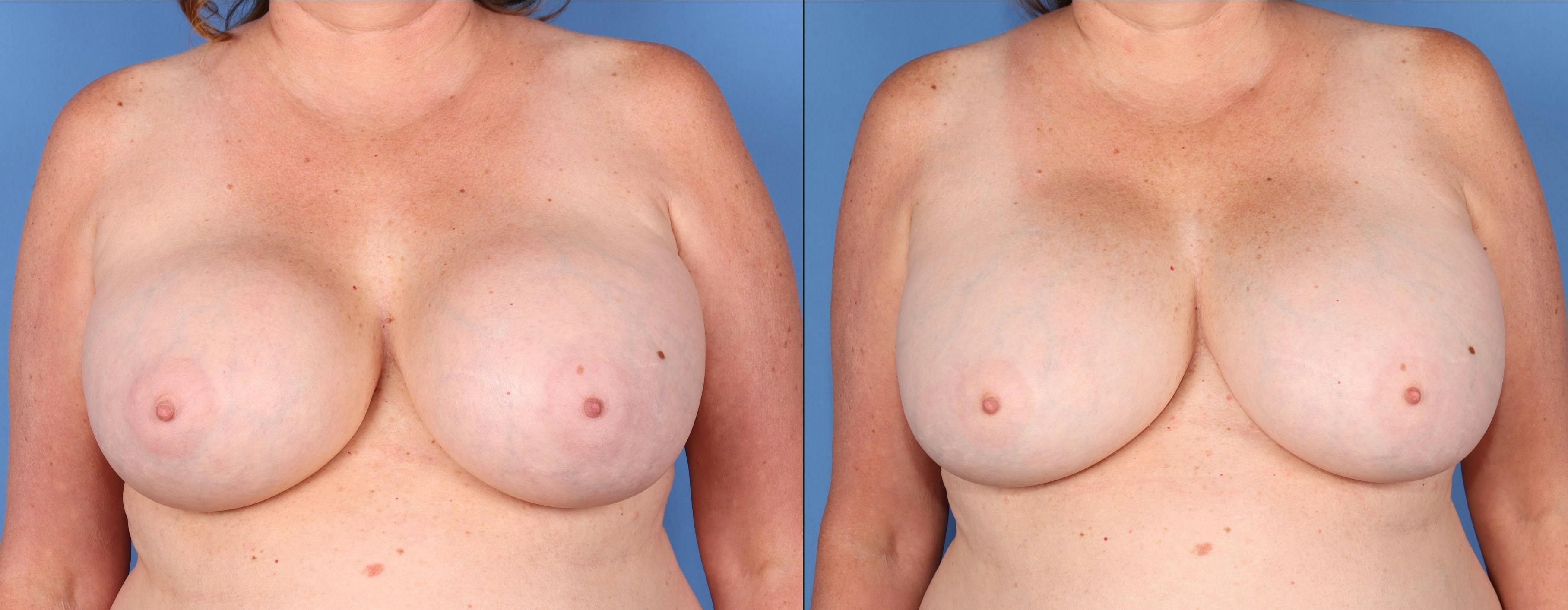 Breast Revision Before & After Gallery - Patient 152534889 - Image 1